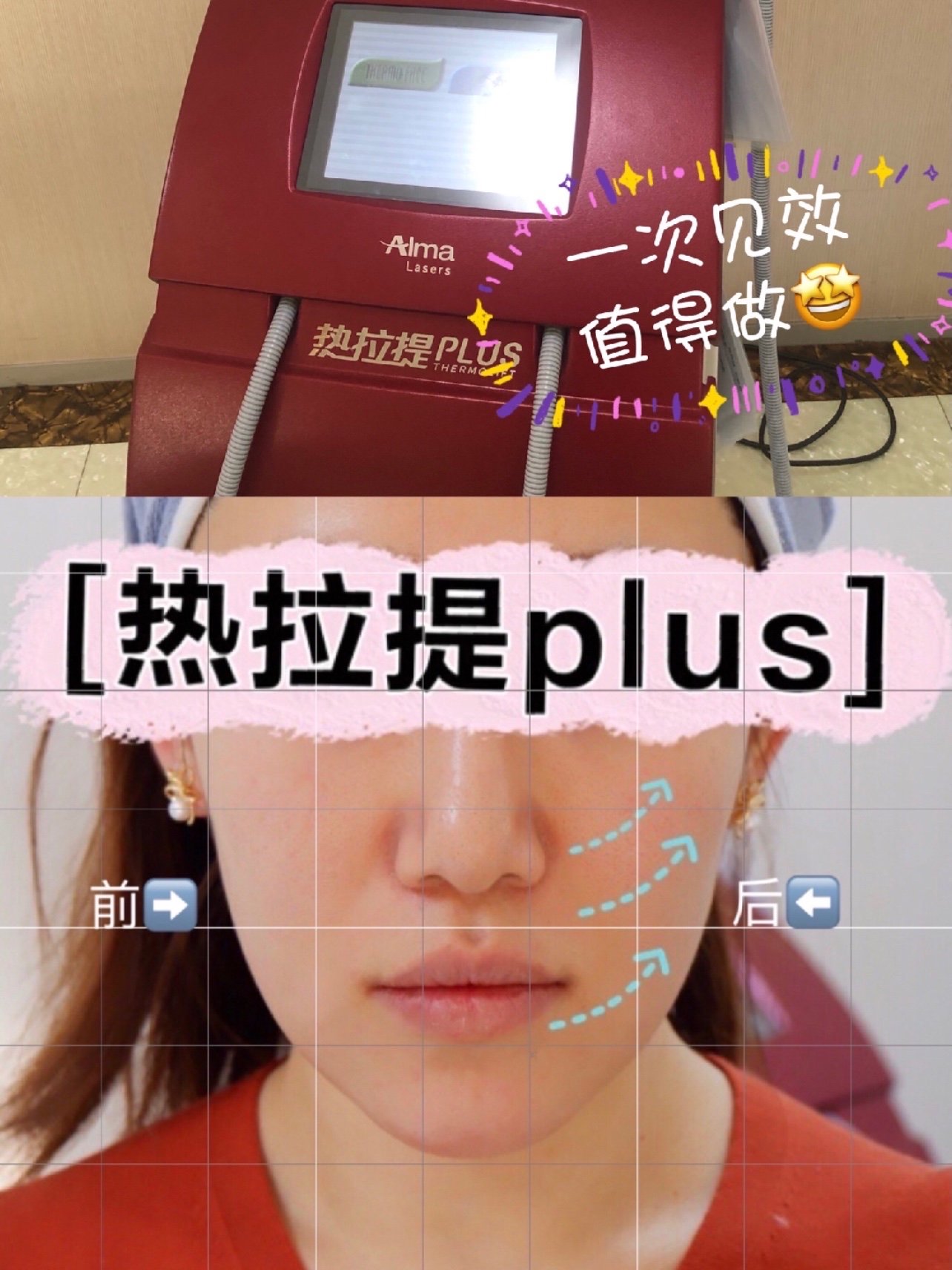 热拉提plus效果 热拉提plus结果
（热拉提plus怎么样） 磁力珠