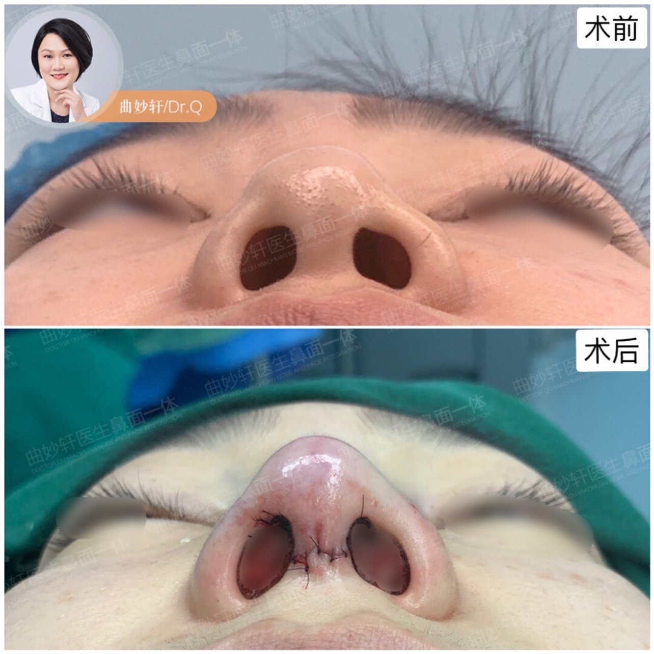 耳软骨鼻部多项这个小姑娘第一次做了单纯l型假体隆鼻_圈子-新氧美容