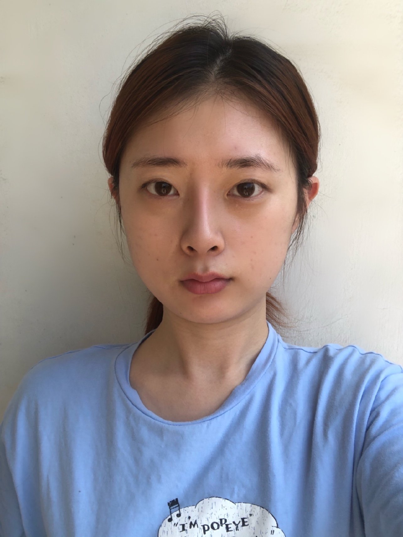 术前单眼皮眼距过宽眉眼间距过宽双眼无神