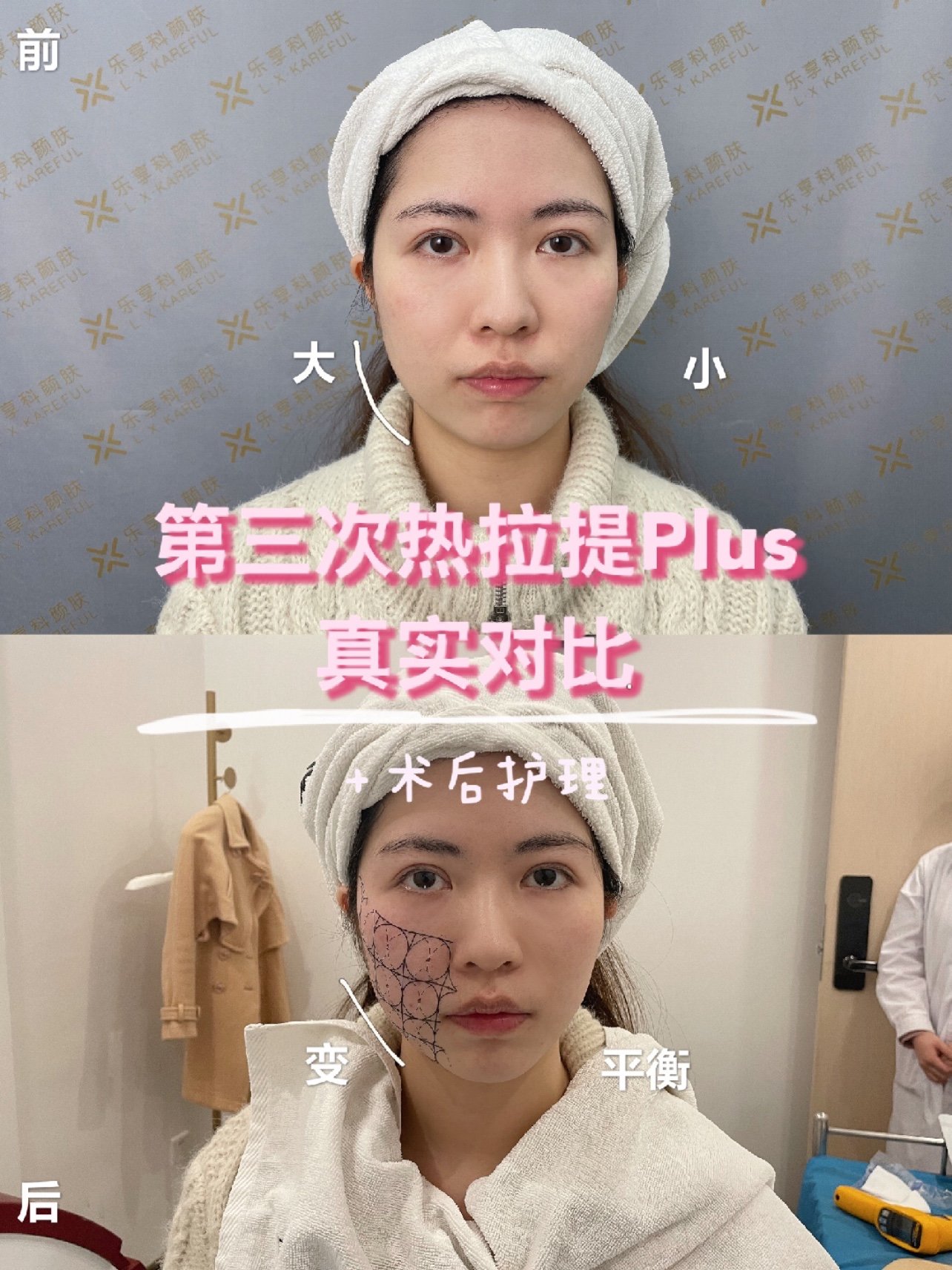 第三次热拉提plus效果对比