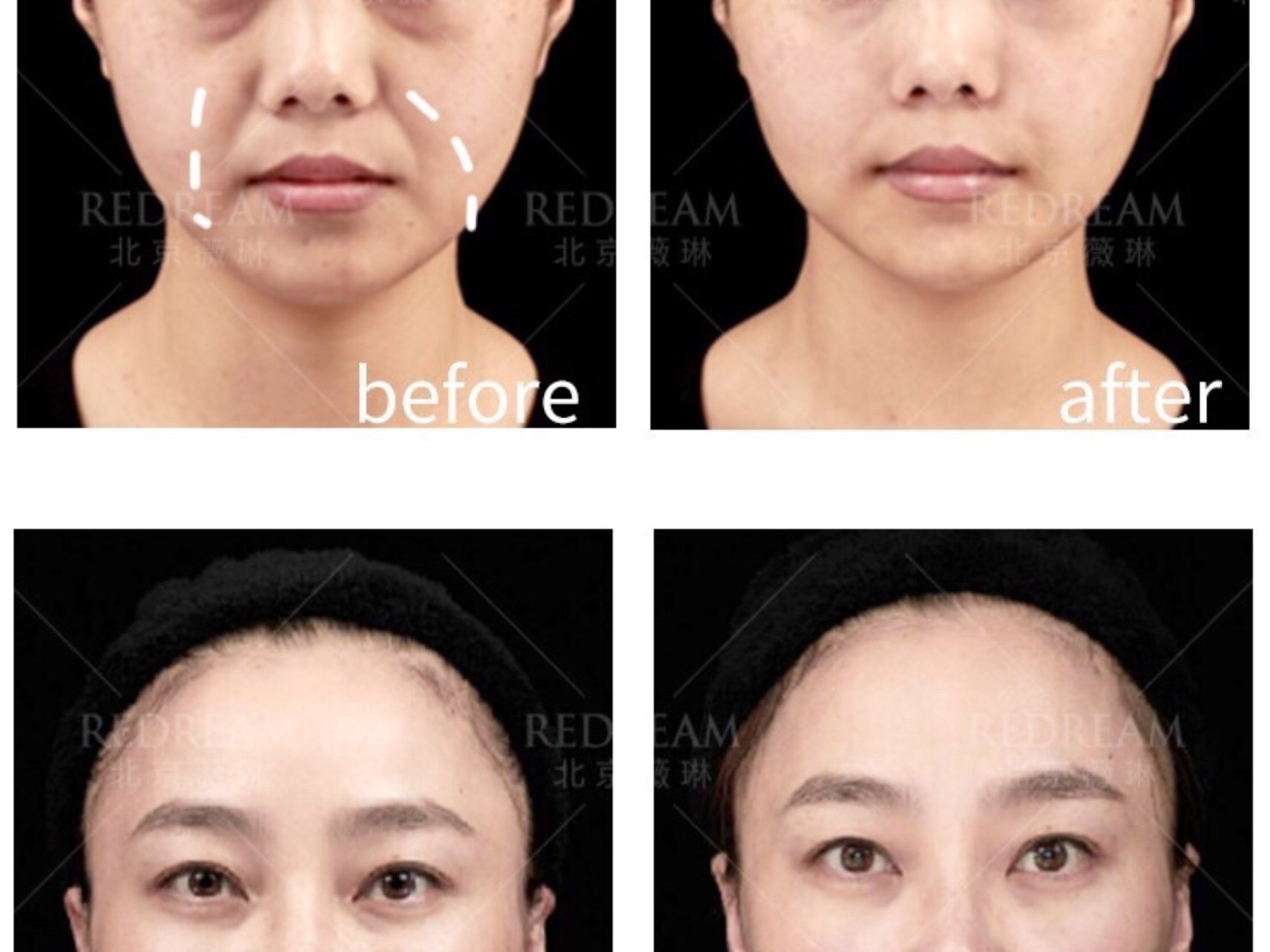 这个"括号"呢,其实就是法令纹——即位于鼻翼边延伸向下的两条纹路.