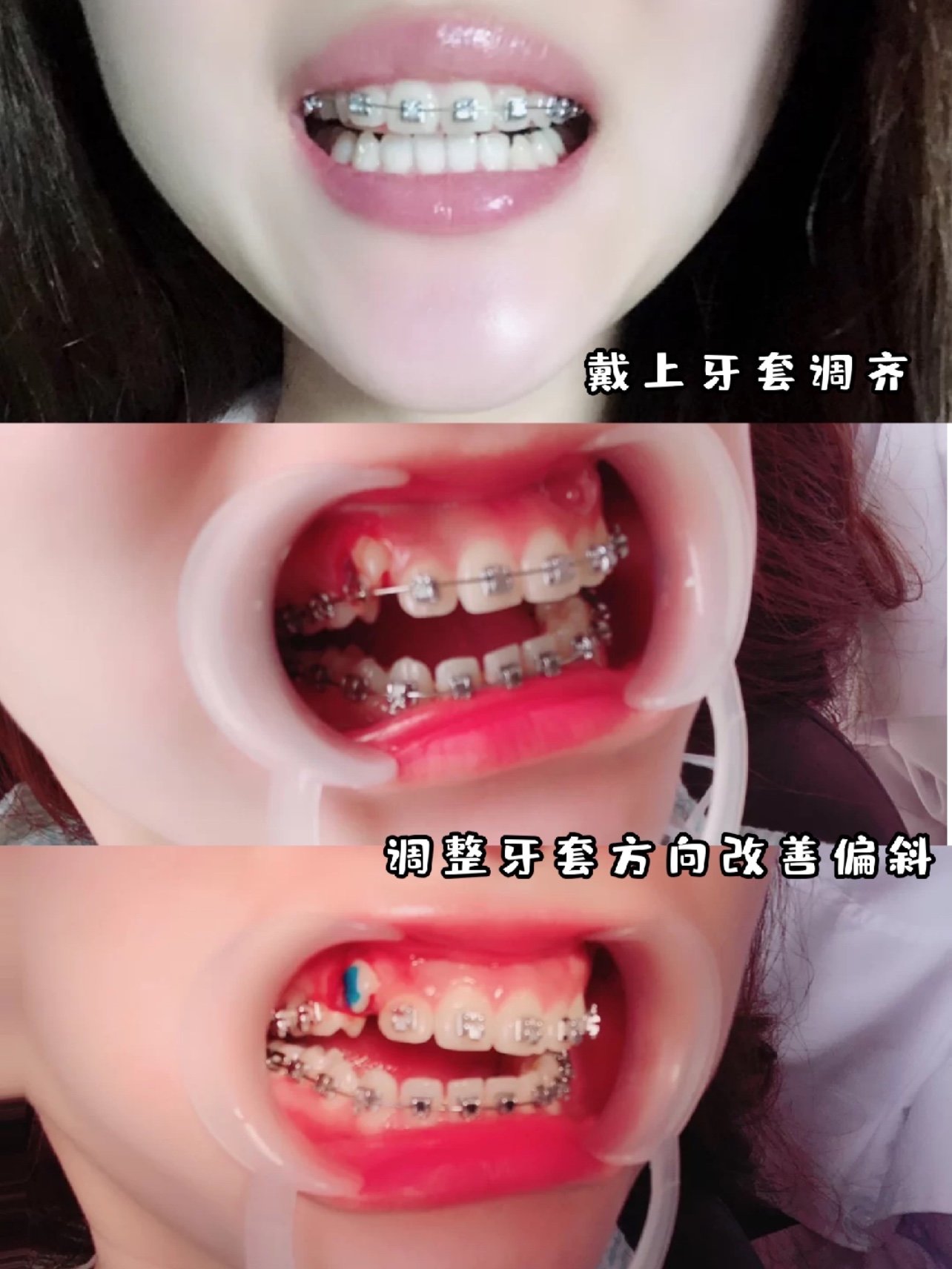 首页 此页面仅支持预览 Avatar 周强 536篇日记 牙齿歪斜改变记录 正畸后原来这么好看 矫正方式 金属牙套 矫正周期 中后期牙齿收缝阶段 牙齿分析 上下牙的咬合比较紧 整体覆盖的程度超过三分之一的正常范围 同时排列不是非常整齐 有门牙和下磨