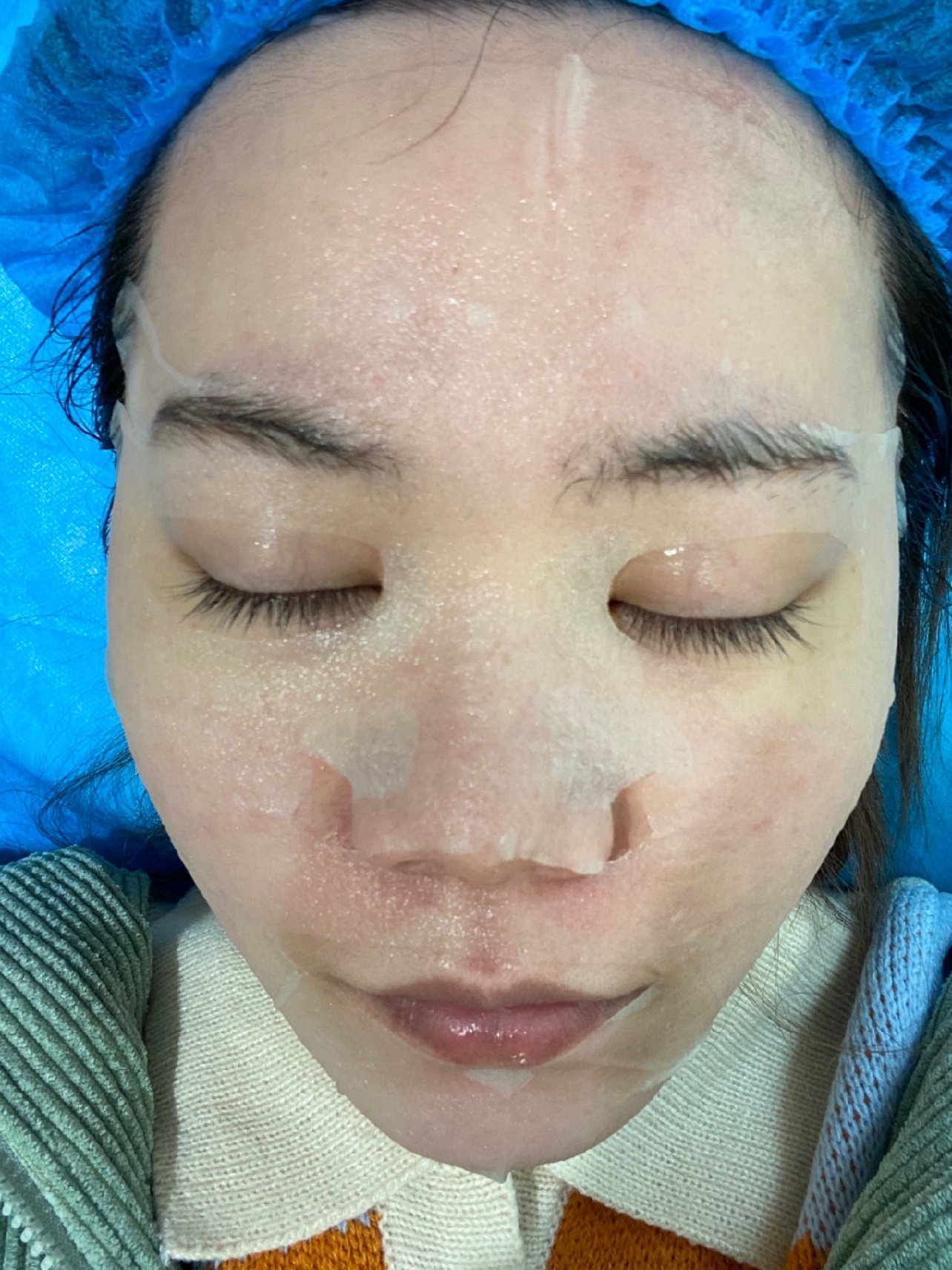 halo大家好,今天去武汉美莱医院做了博乐达超分子水杨酸换肤项目,来给