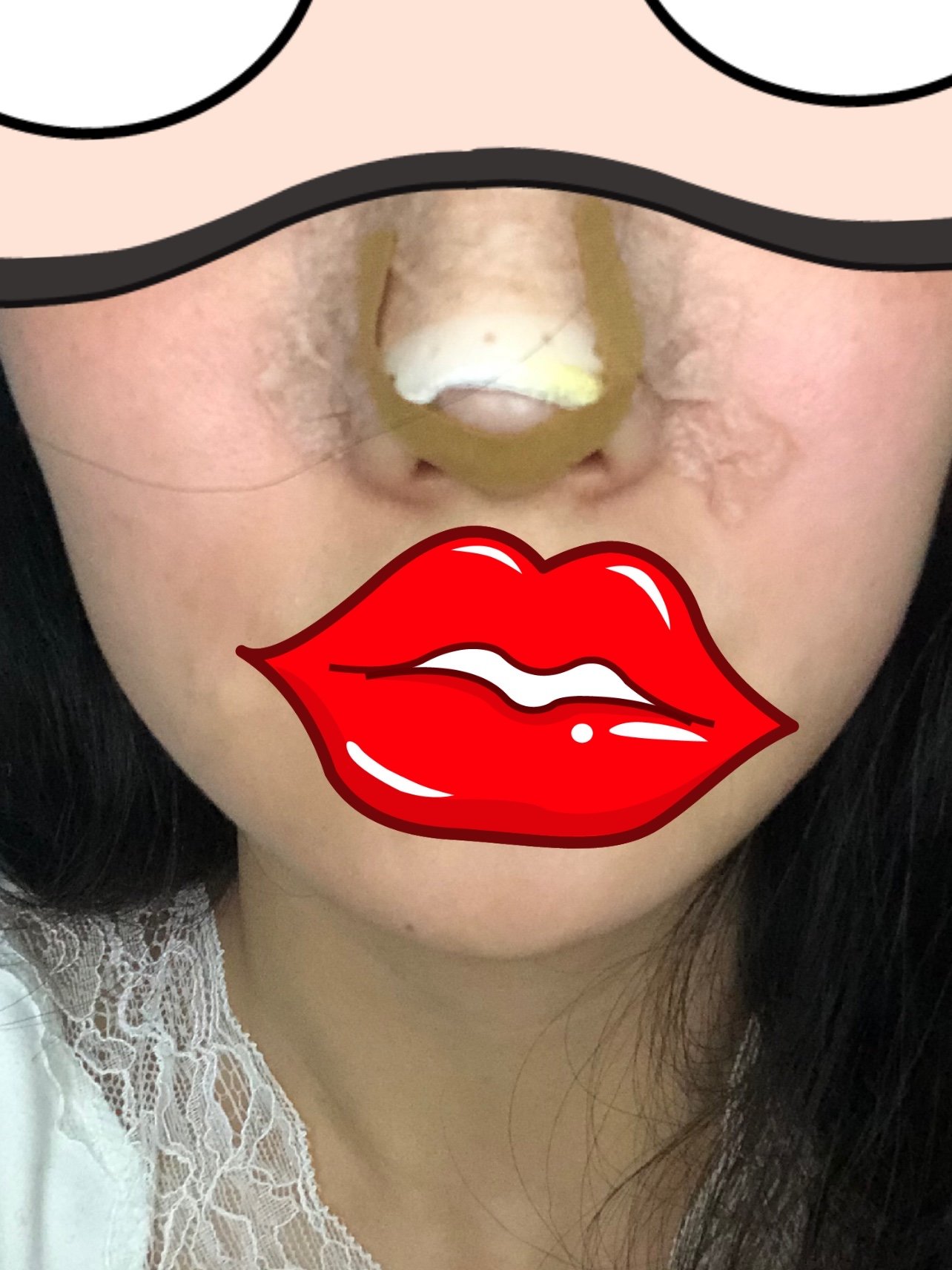 鼻翼整形手术_鼻翼整形大概多少钱_鼻翼整形术