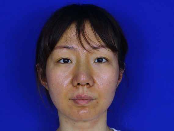 在天津联合丽格第三医疗美容医院做了双萌芽鼻部多项已_圈子-新氧美容