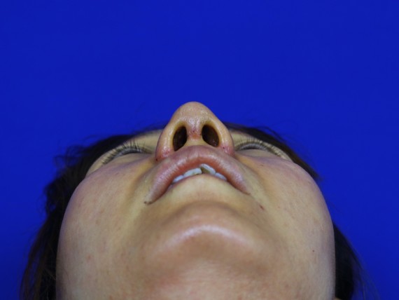 在天津联合丽格第三医疗美容医院做了双萌芽鼻部多项已_圈子-新氧美容