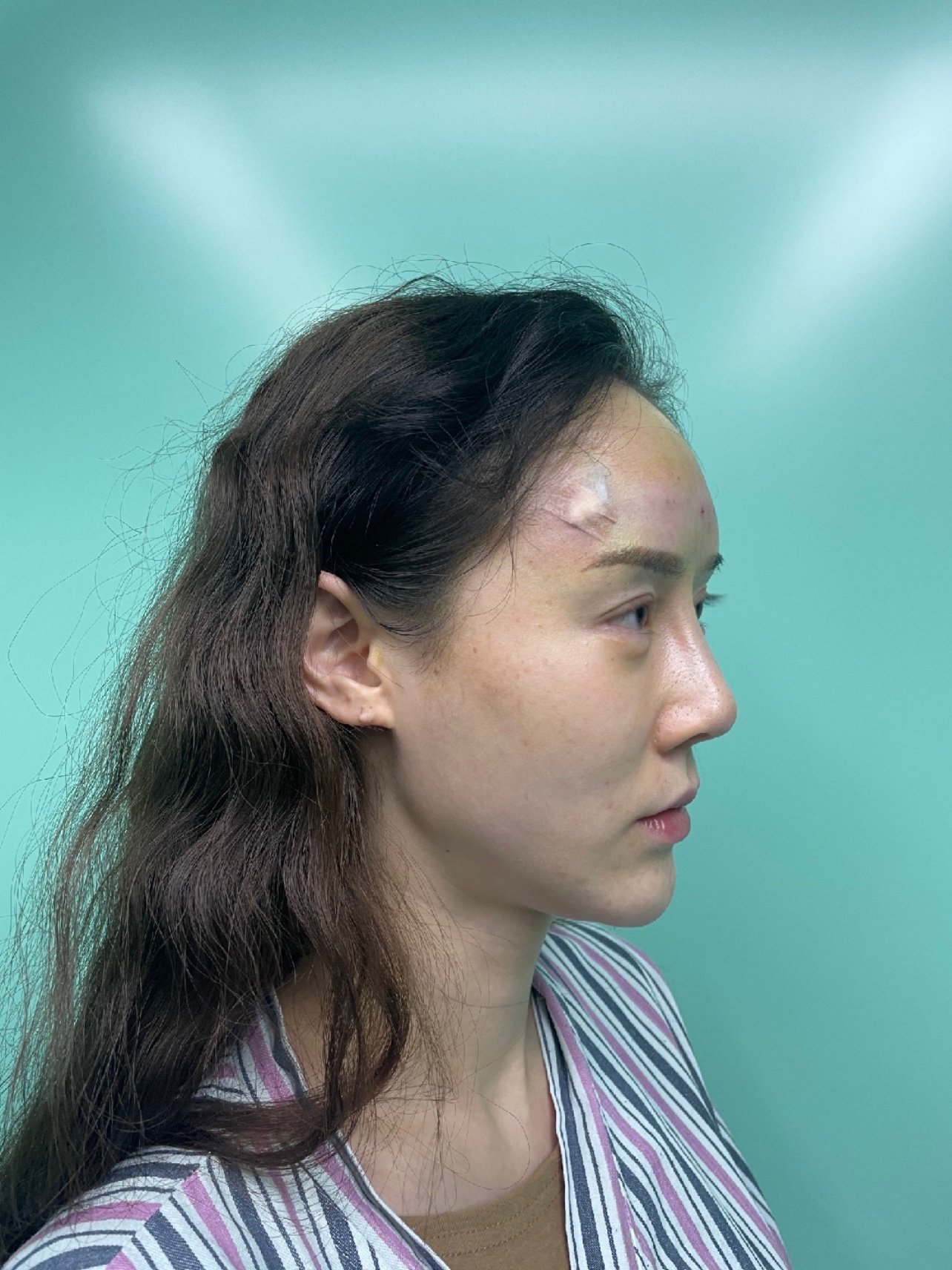 我之前做过自体脂肪丰额头但是成活率很低,效果并不理想后来在平台上