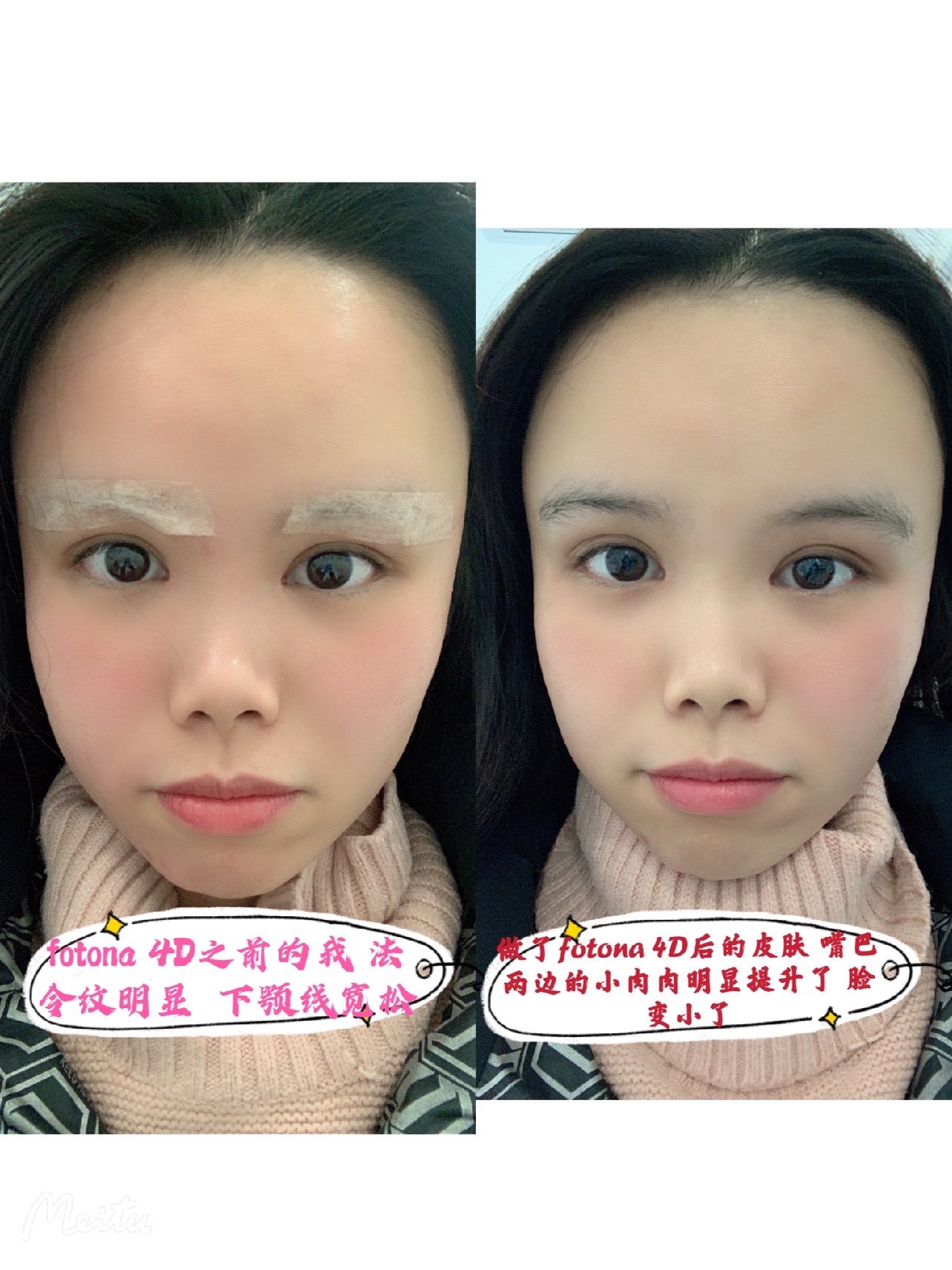 新氧试用官fotona4d