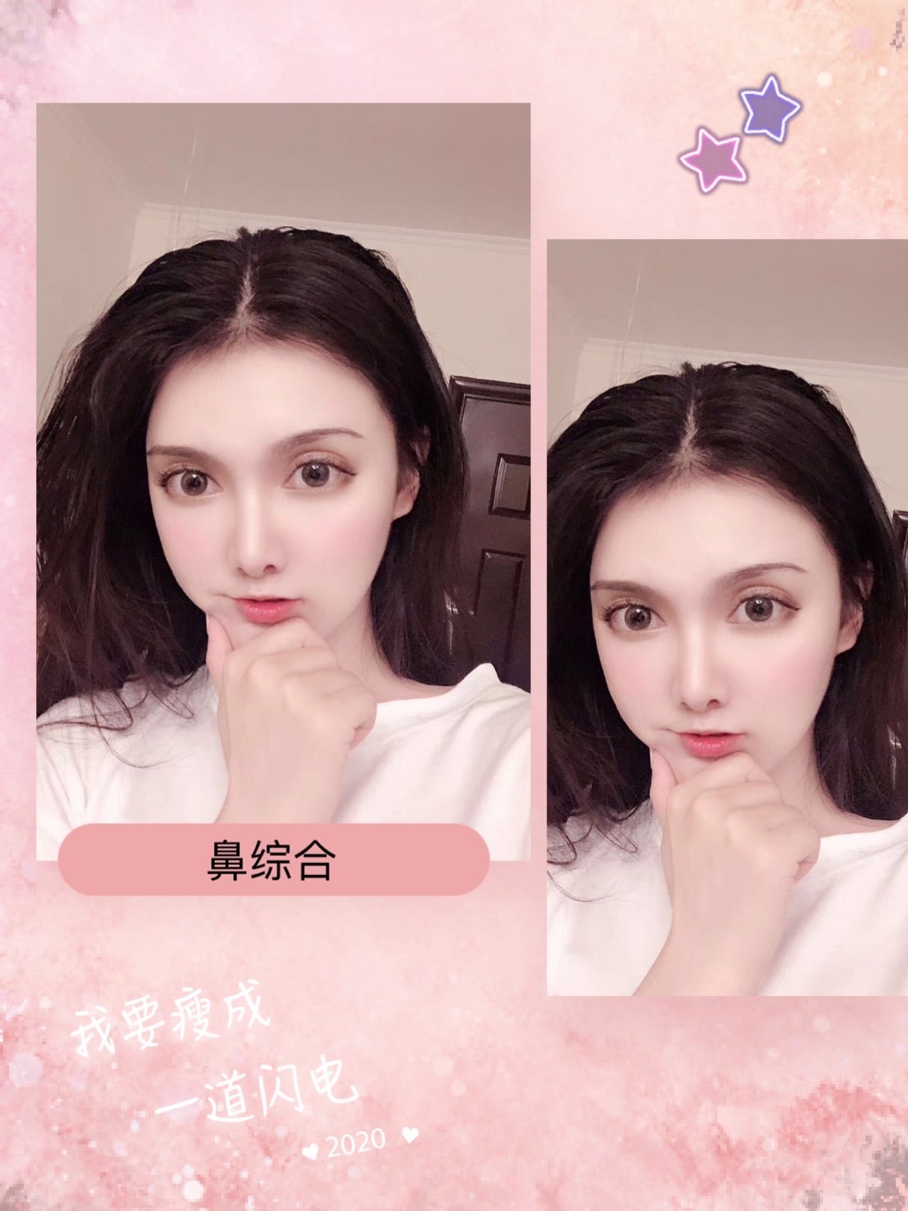 鼻子两年多了,一直都是我喜欢的那只小翘鼻,鼻头可以_圈子-新氧美容