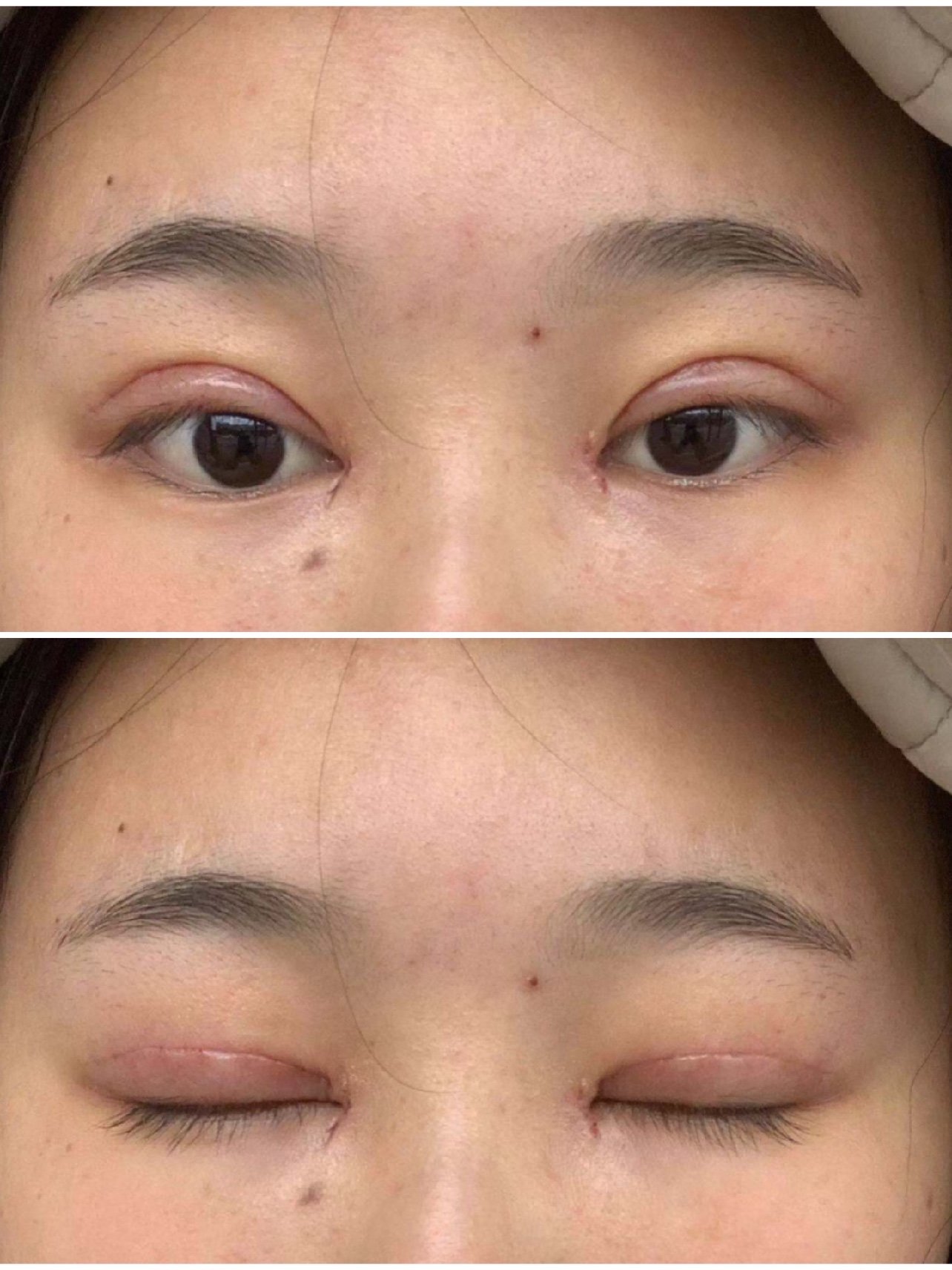 恢复快的全切双眼皮案例分享