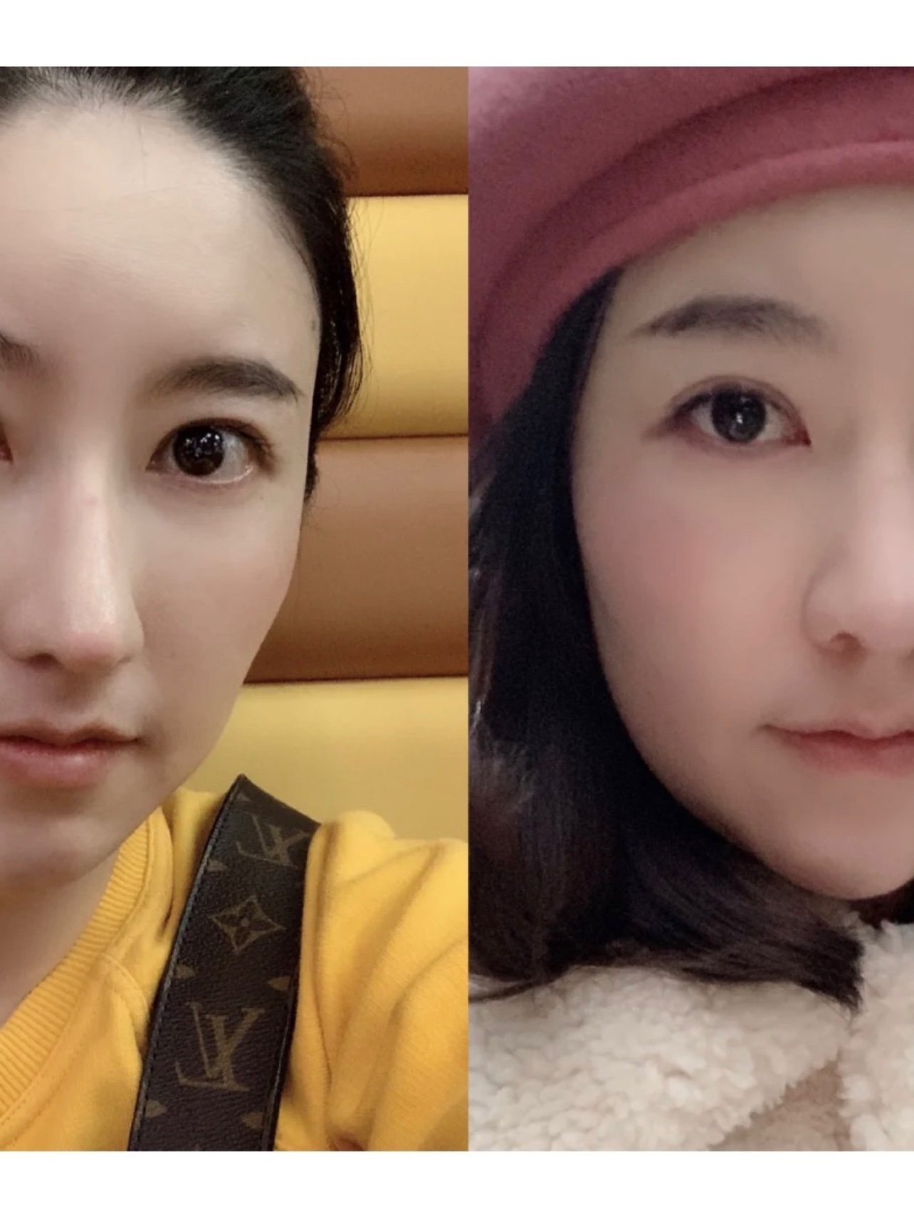 巫婆鼻修复之前的鼻头都要掉下来了像个"老巫婆"丑死_圈子-新氧美容