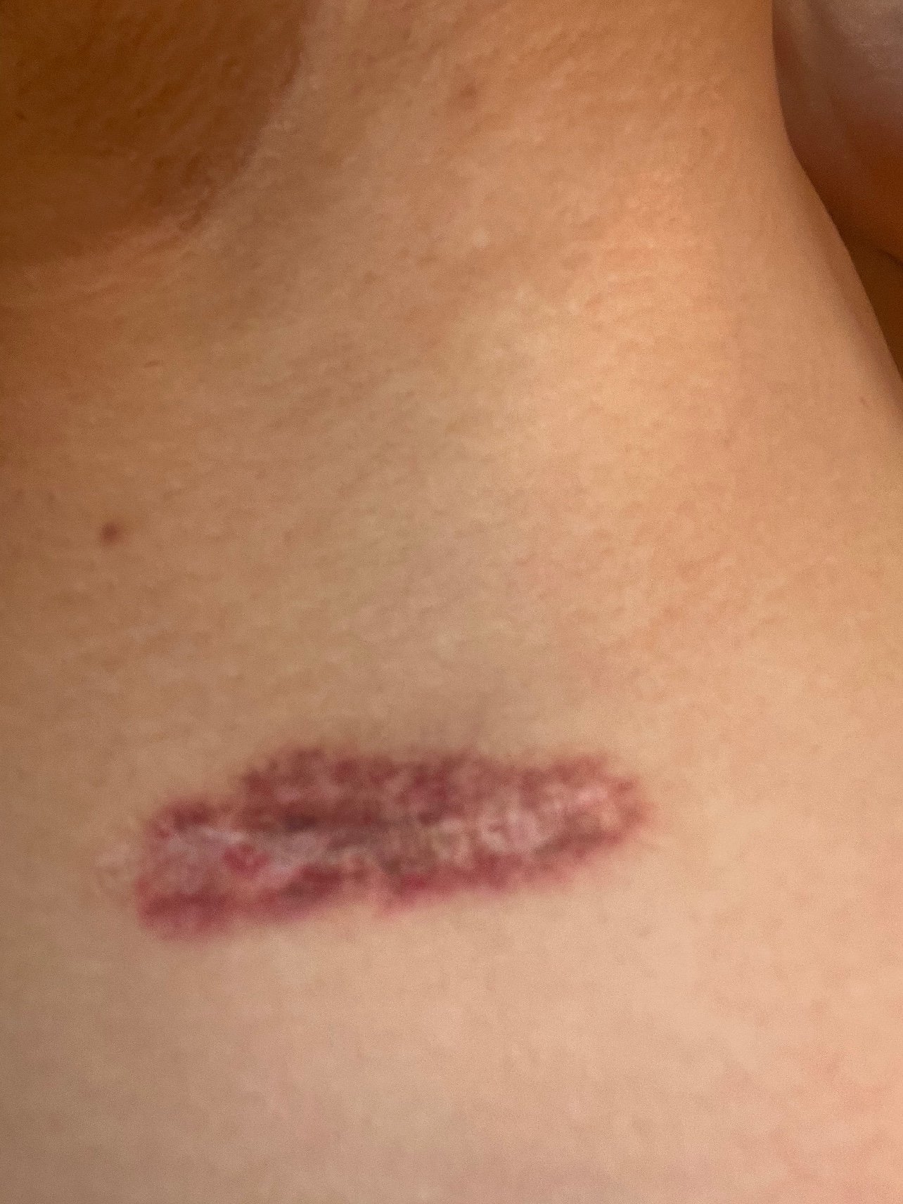 起搏器手术后疤痕图片图片