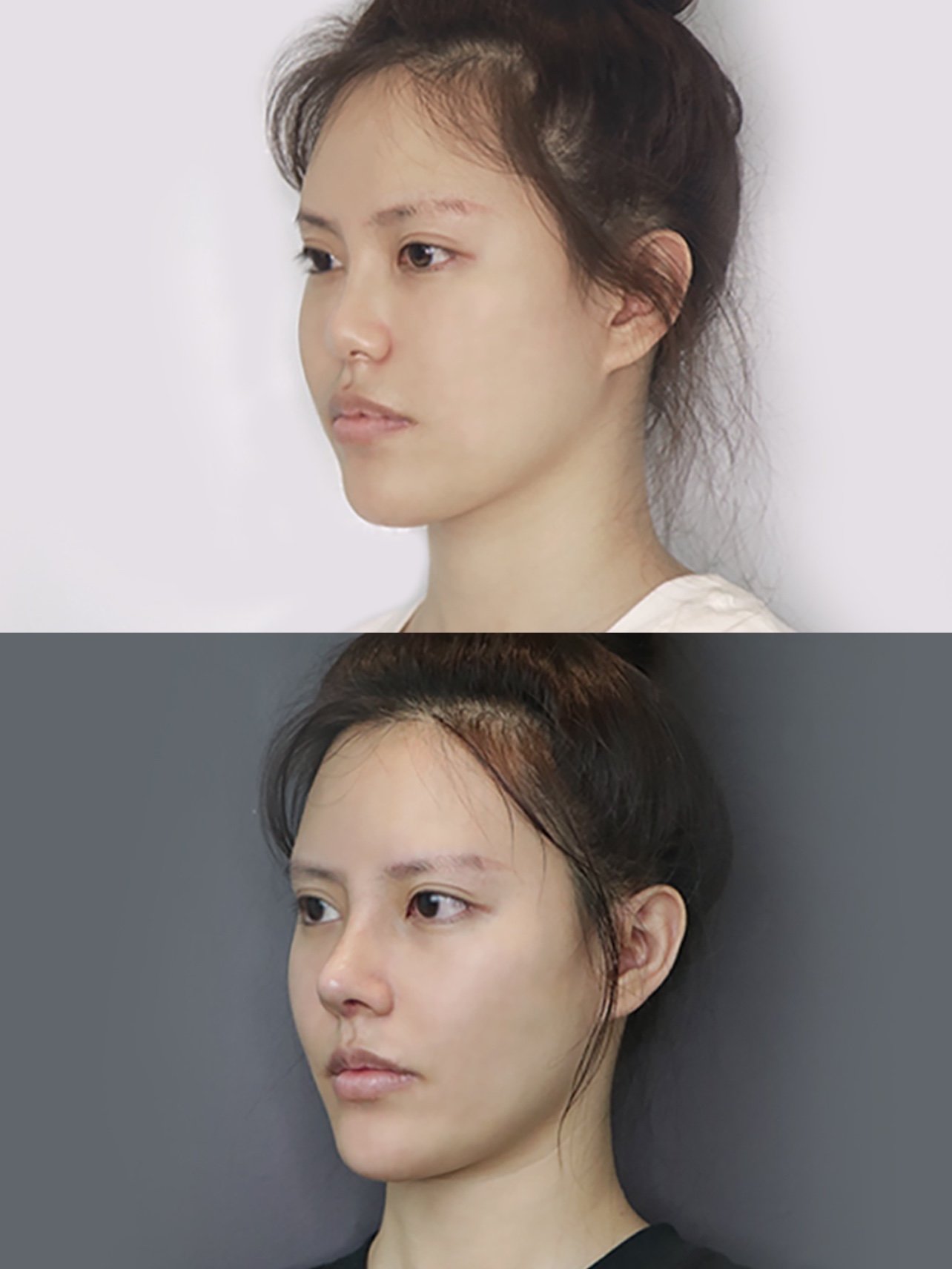 鼻背填充物注射史,鼻基底严重凹陷,鼻尖下旋,鼻尖上_圈子-新氧美容