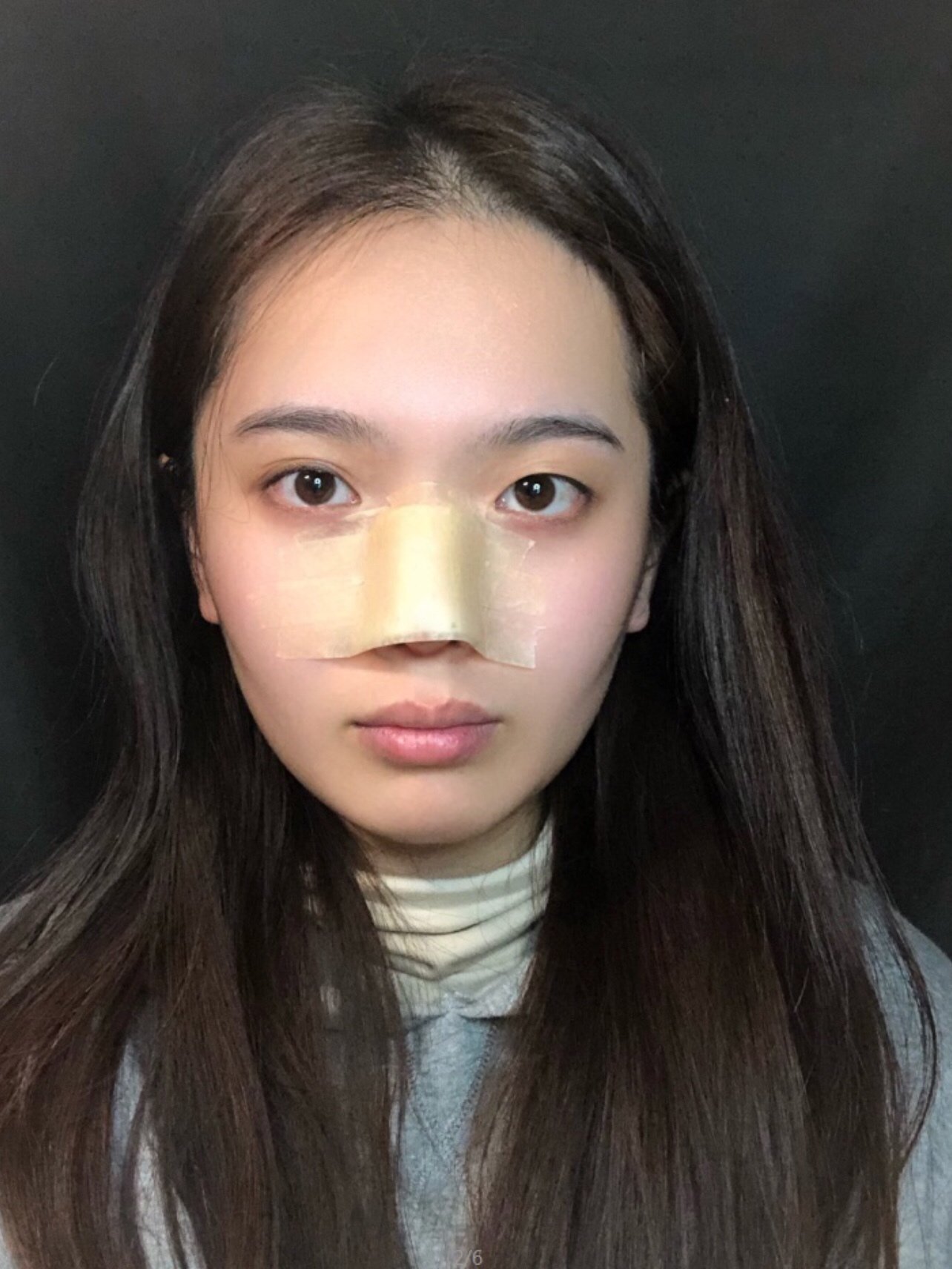 【术后恢复期分享】做完鼻子之后会包扎一下鼻子的,这_圈子-新氧美容