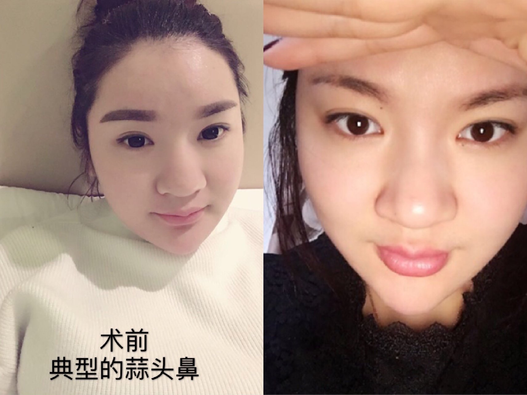 蒜头鼻如何蜕变小翘鼻?