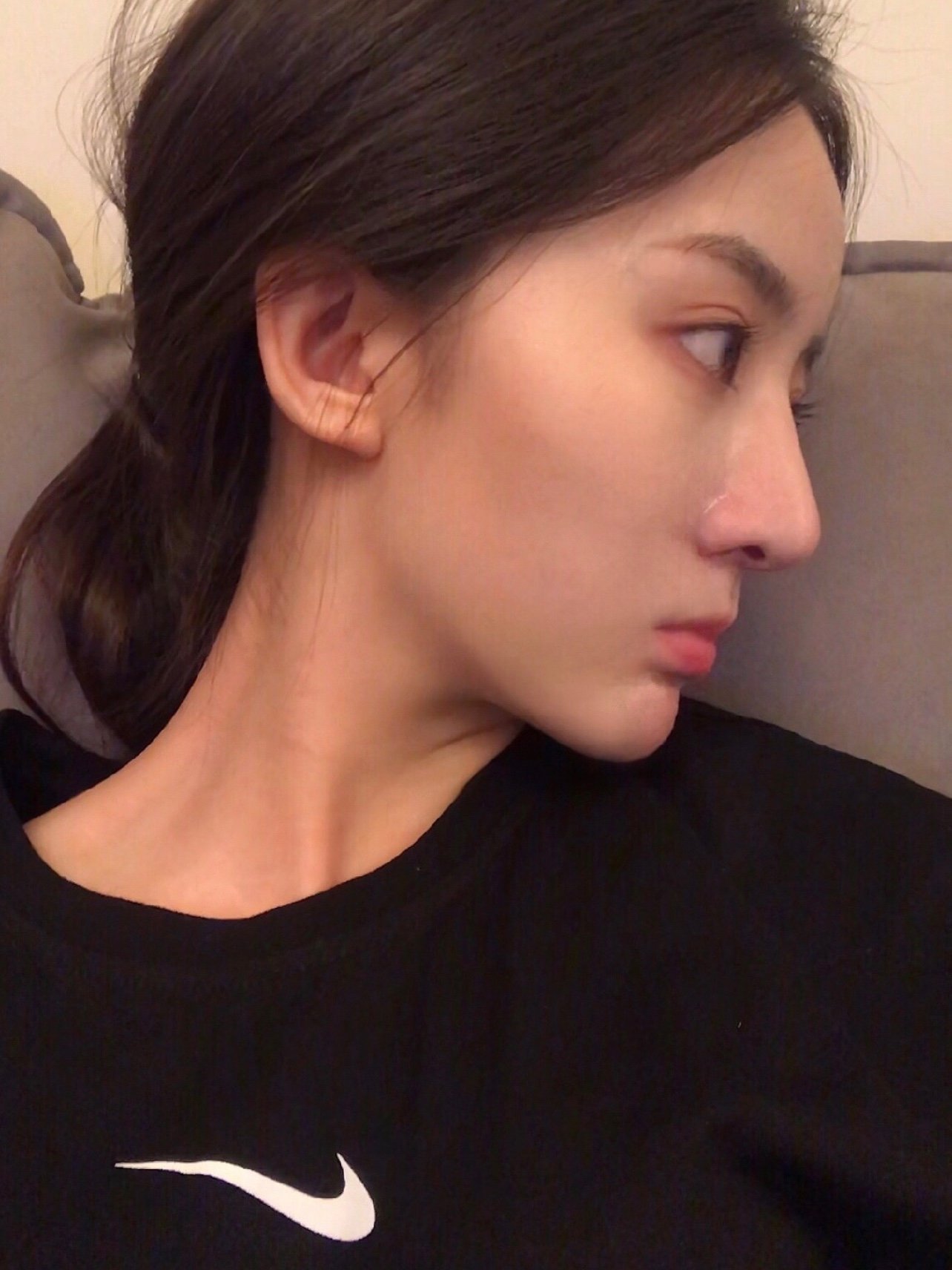 对比了术前扁鼻子的照片,隆鼻之后改变很大,现在已经_圈子-新氧美容