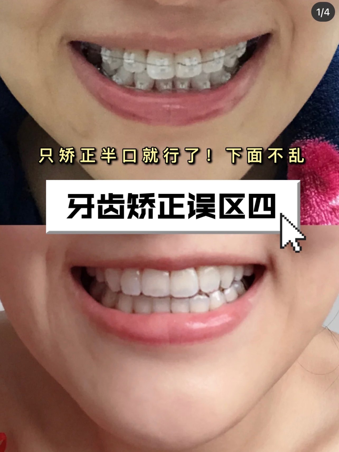 牙齿矫正误区:可以只矫正半口!