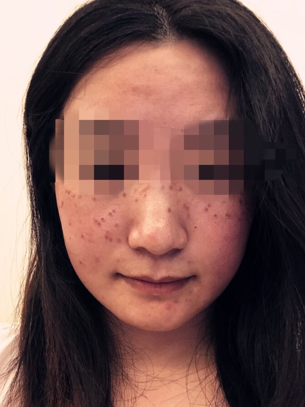 皮肤偏黑,本身有斑,防晒做的不到位,导致斑点越来越多.