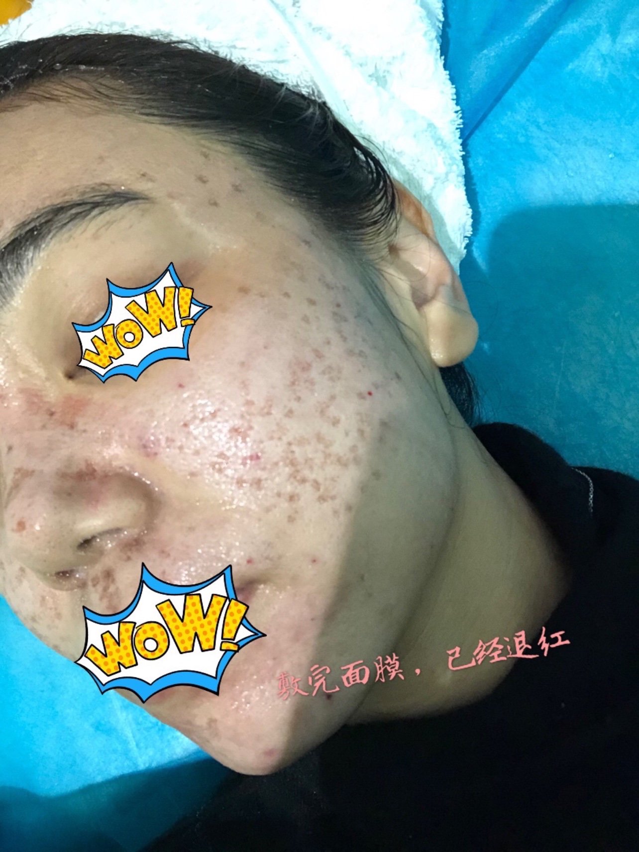 点阵激光注意7215图片有点辣眼睛终于又下定决心去做点_圈子-新氧