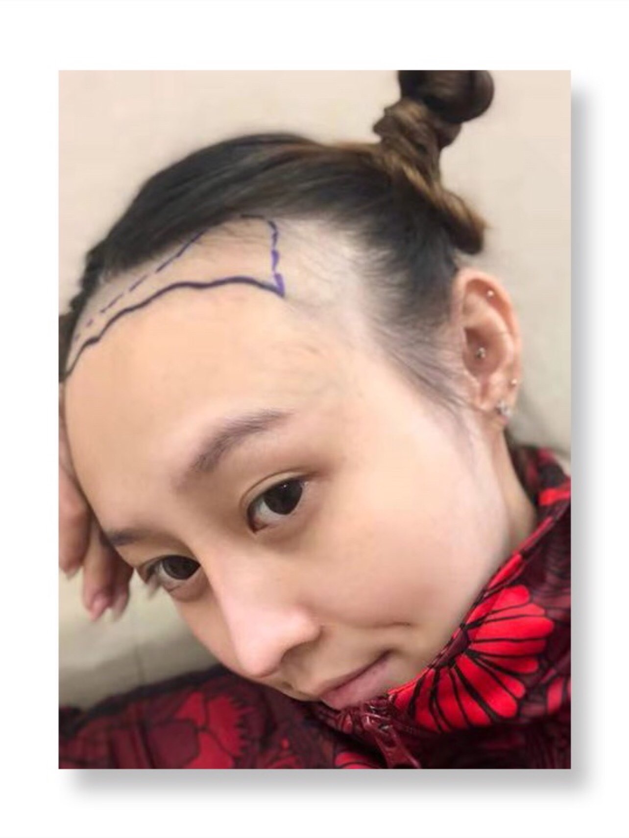 种植的头发生长自然了,虽然只有正常刘海的长度,但相_圈子-新氧美容