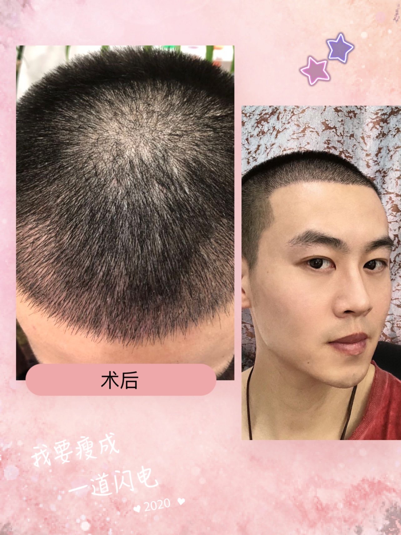 大麦微针植发·术后7天7373经过这几天的恢复,现在的_圈子-新氧