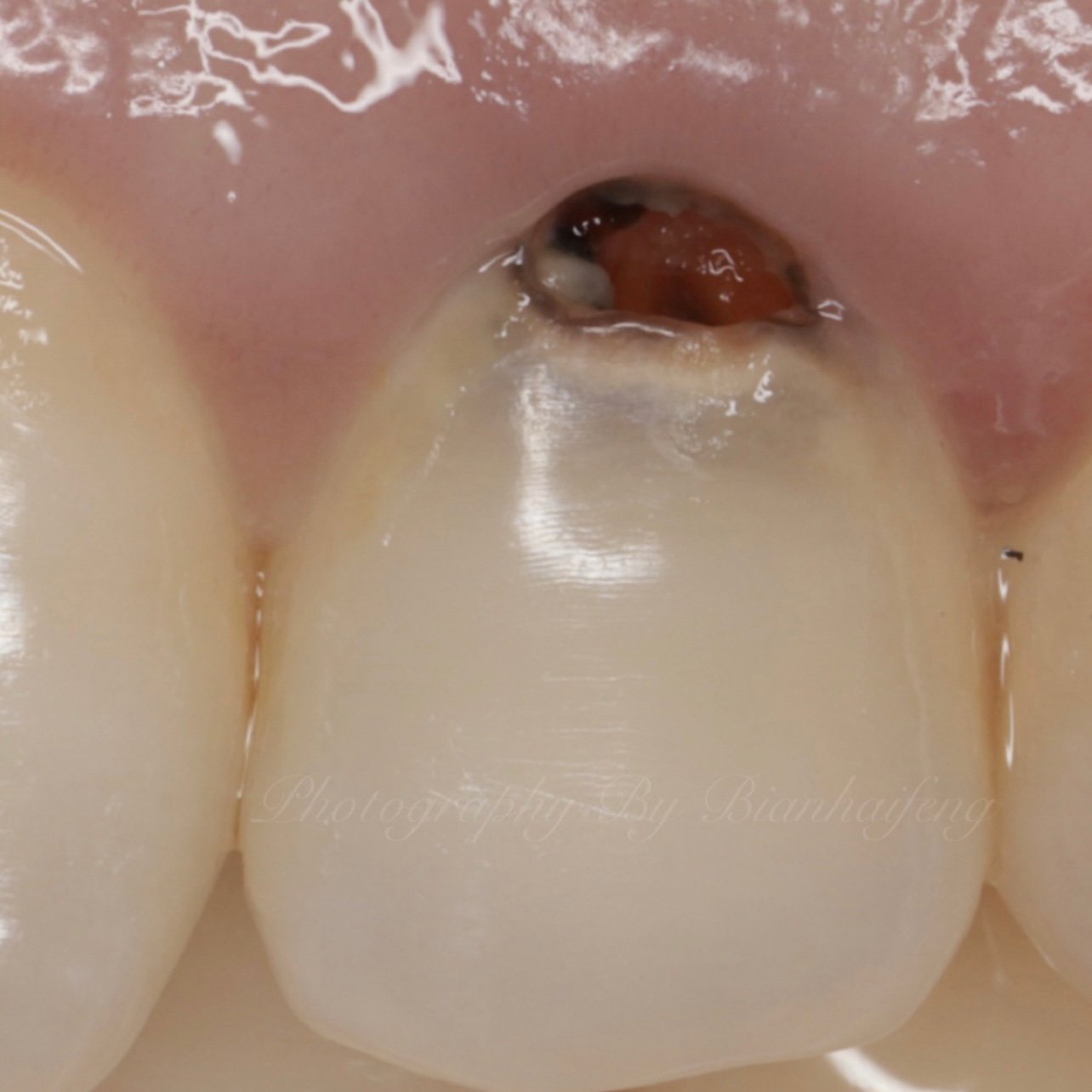 门牙龋坏树脂补牙门牙龋坏影响美观,那就用树脂直接补