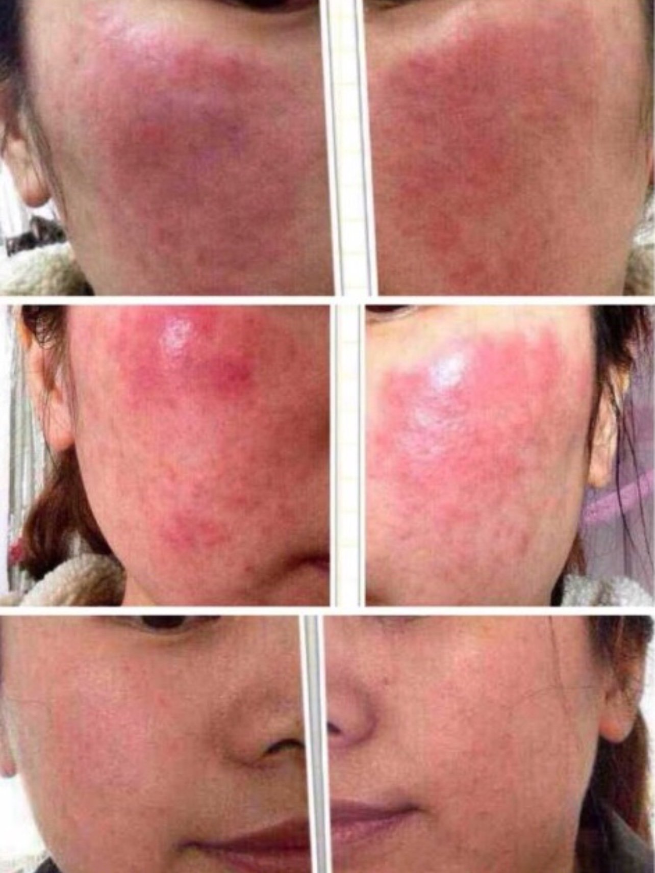 皮肤易过敏并不一定是敏感肌哦!