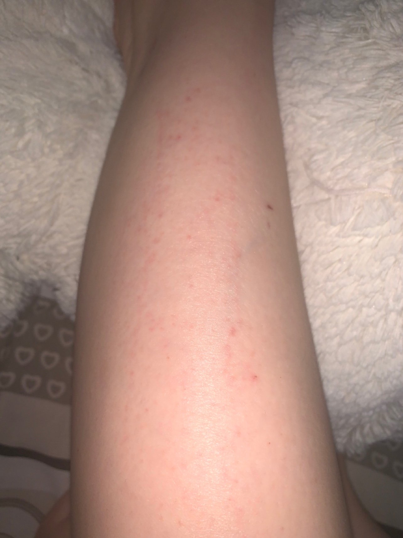 小腿小臂被刮毛刀刮伤了皮下有很多出血点洗澡才发现手上很痛无论怎样