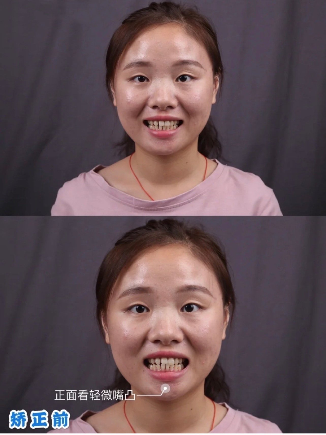 牙齿矫正小姐姐迈出变美的第一步