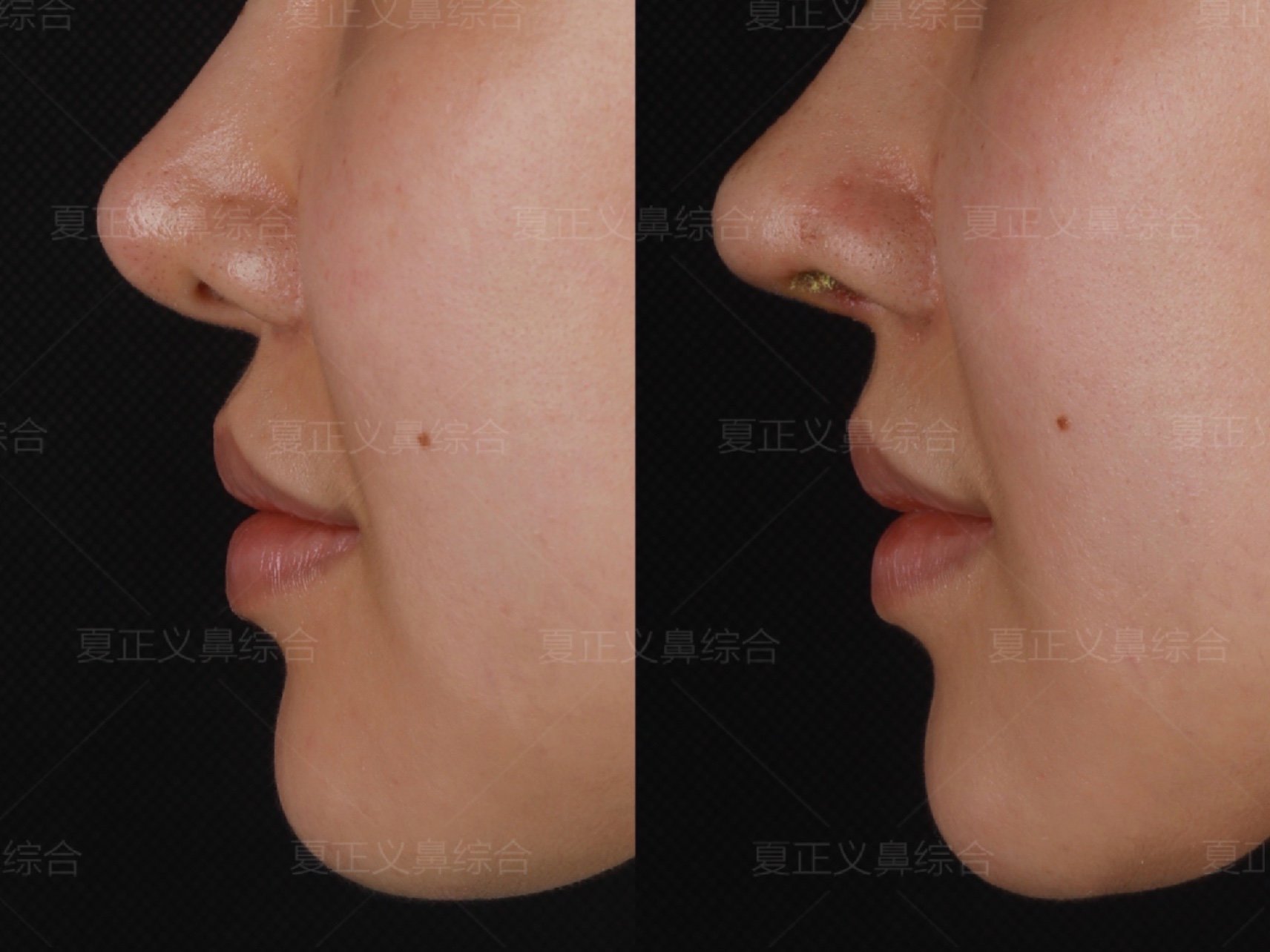 鼻小柱发育退缩会是嘴部显突的一个原因.