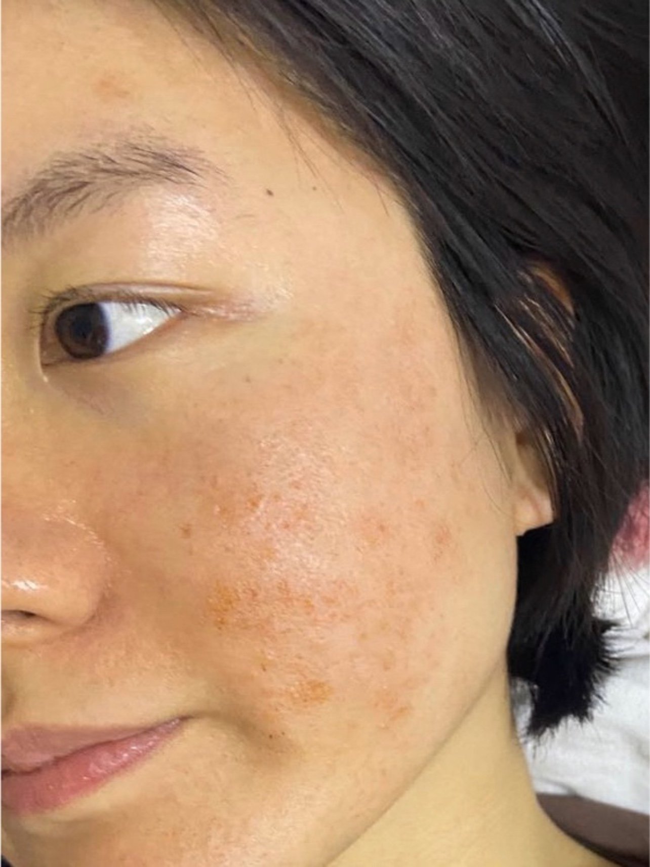 对抗8年老痘坑二氧化碳点阵激光分享