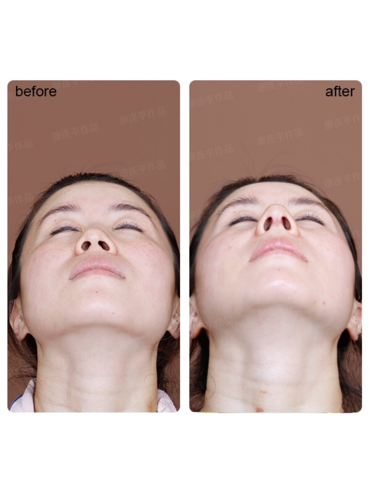 周长不一致,鼻歪 顾客诉求:直鼻微翘 山根不要太宽 手术名称:半肋