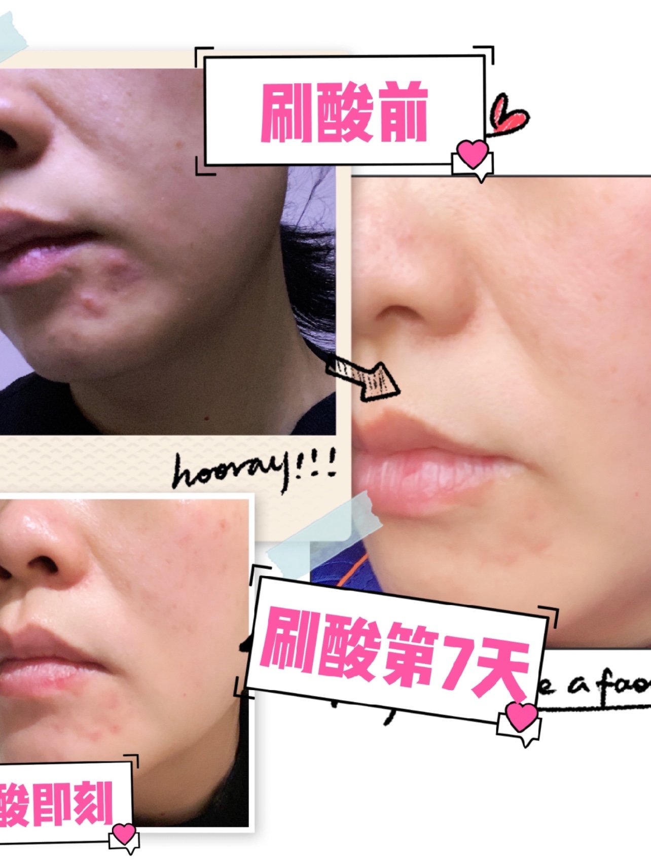 博乐达超分子水杨酸面部刷酸体验第二篇