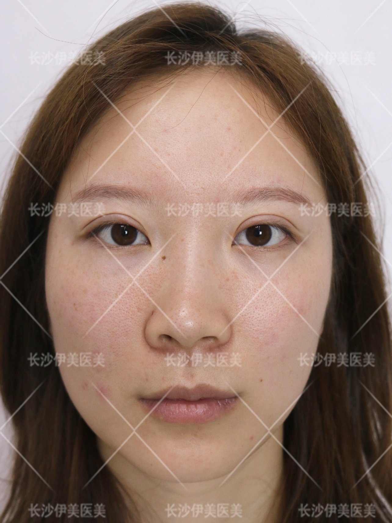 全切双眼皮术后双眼皮宽假深,肉条感,眼睛无神.