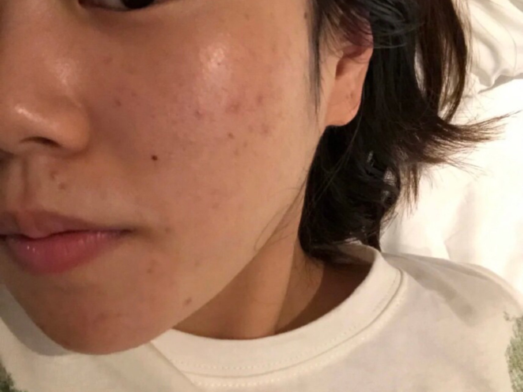 我这个油痘肌终于敢前置摄像头拍自己皮肤了