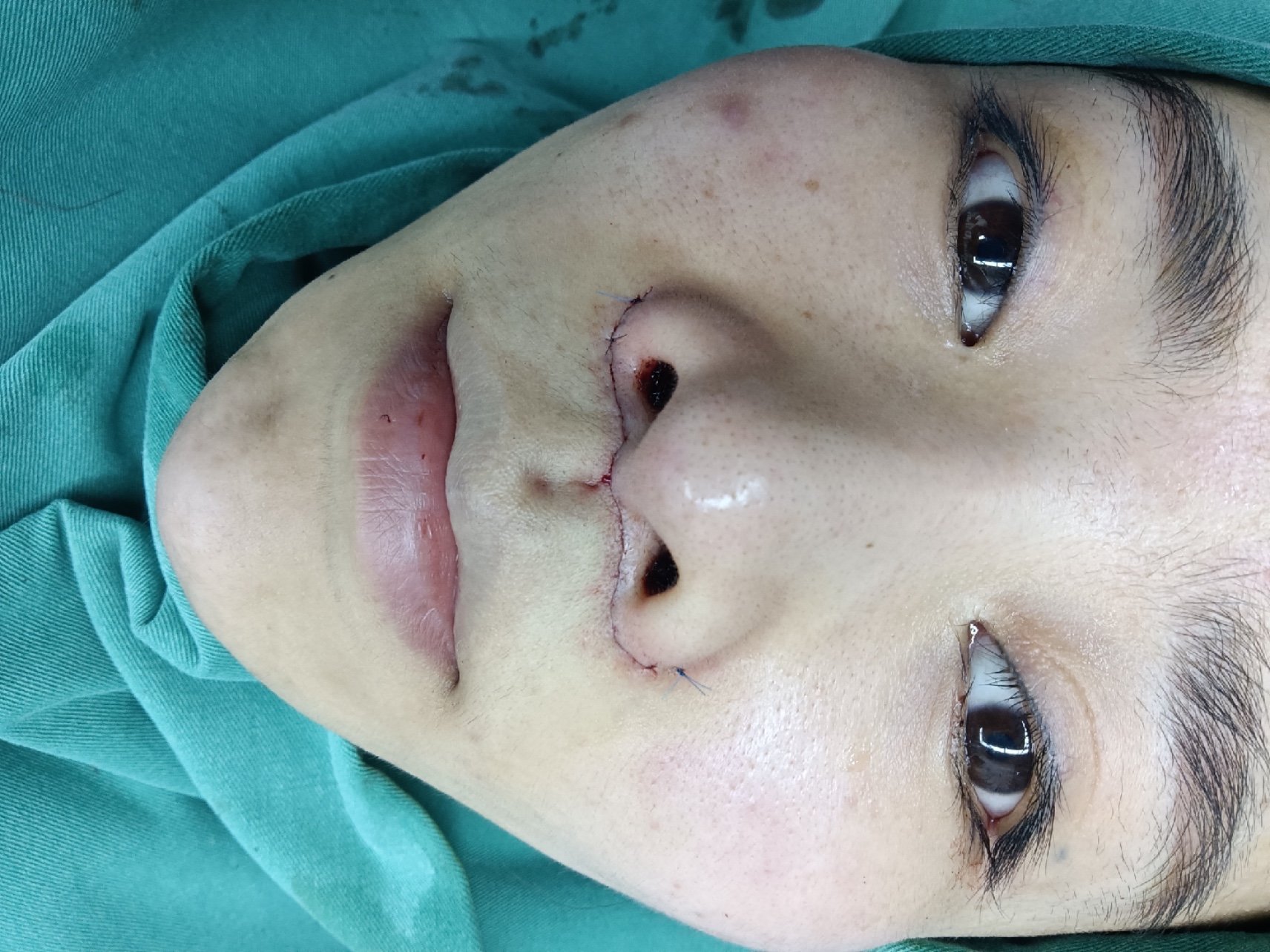 缩短77人中窝加深没失望反正是内缝合技术疤痕_圈子-新氧美容整形