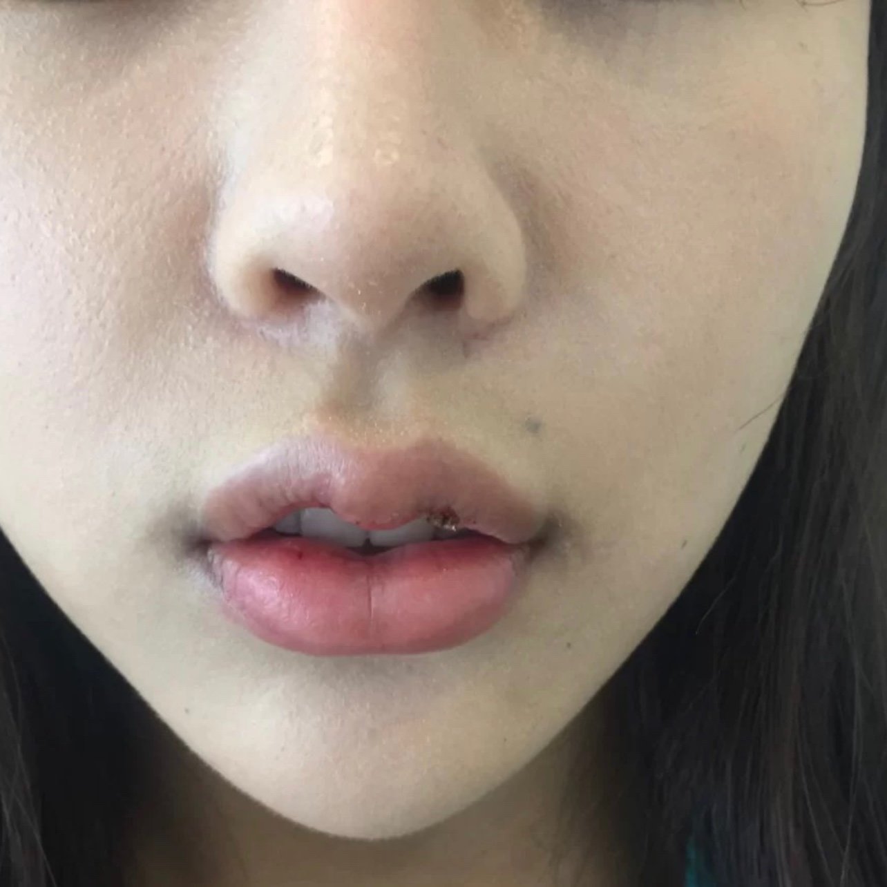 在尤美这家医院做的m唇的术后效果我是真的特别的满意的.