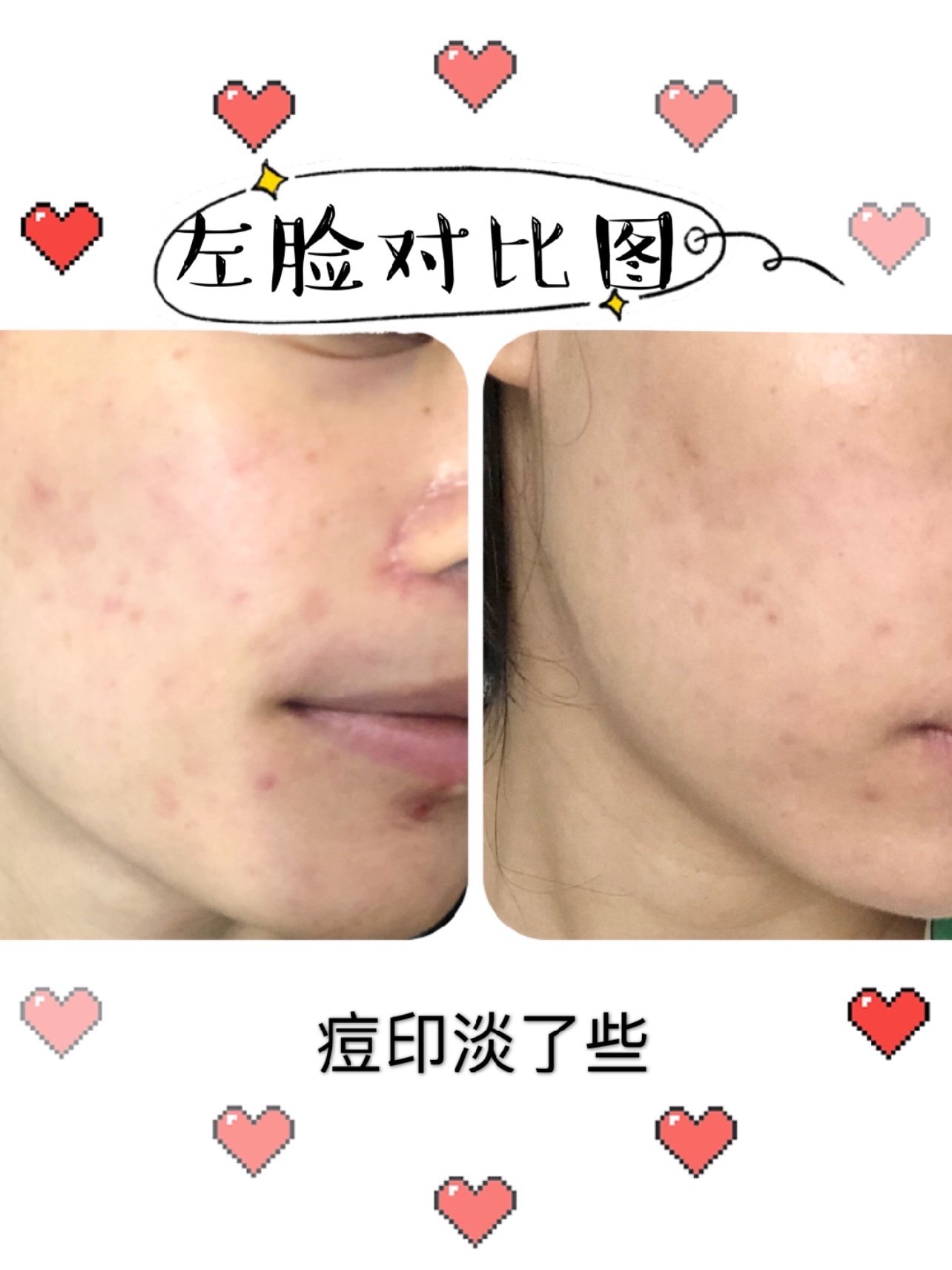 新氧体验官博乐达水杨酸 刷酸后11天皮肤状态对比