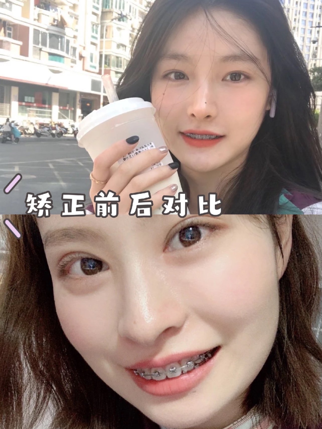 目前进度:中期内收阶段 术前分析:门牙与上牙的整体牙齿都有外翻痕迹