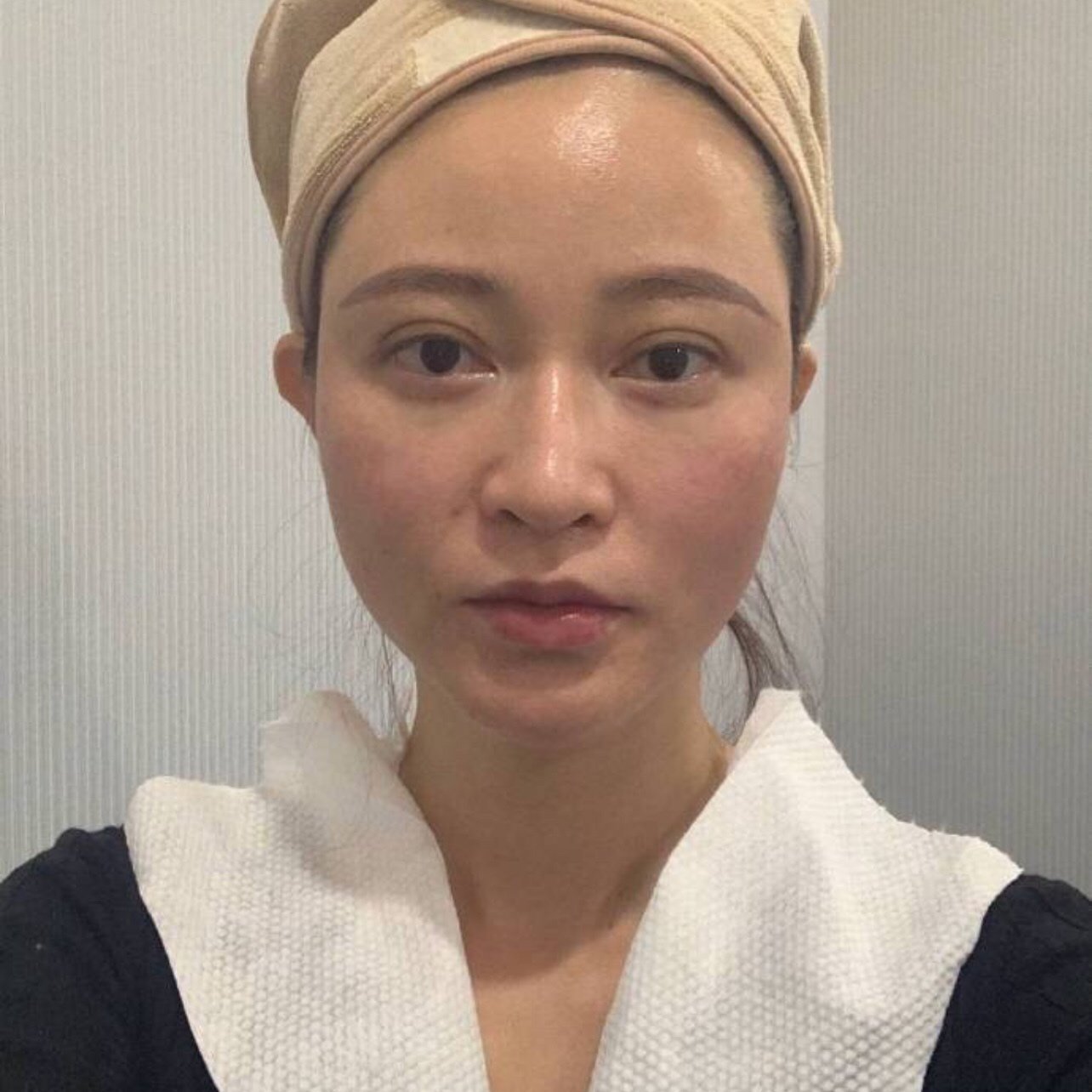 我脸颊有点下垂了,来面诊之后,医生说我更适合做线雕_圈子-新氧美容