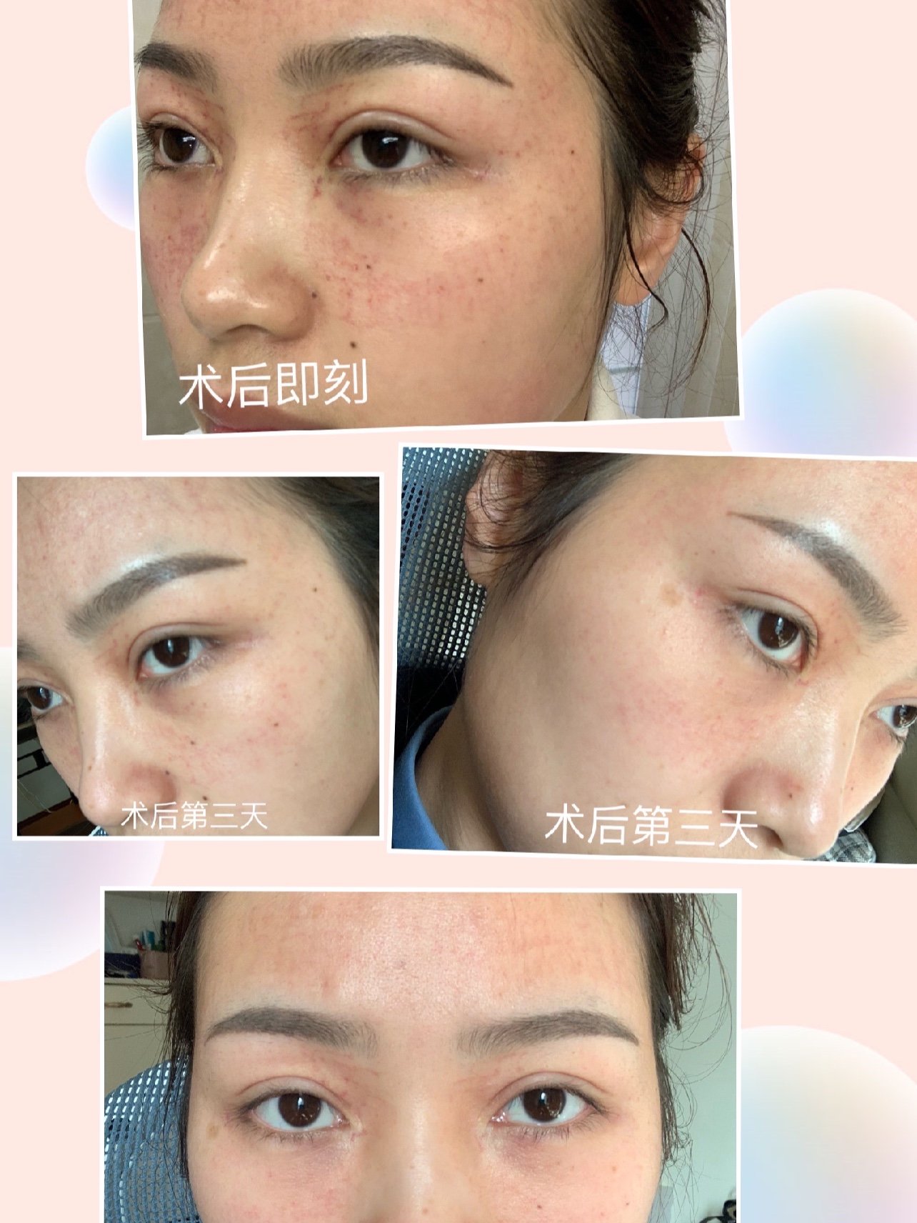 眼部黄金微针第35天打卡000000