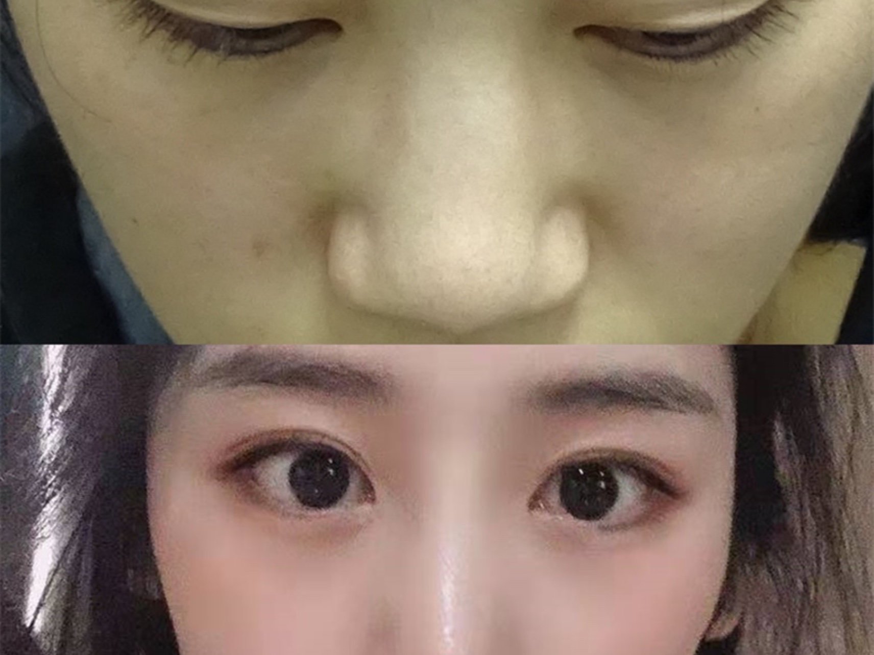 整形外科手术中,鼻翼明显肥大且外扩严重的患者,确定需要通过鼻翼缩小