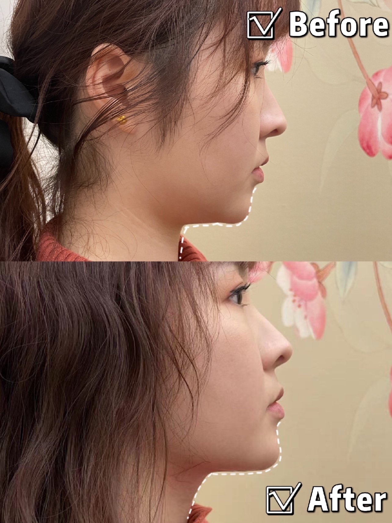 相信不少宝宝一低头下巴都有一坨肉,但不管正面还是侧面看,只要有双