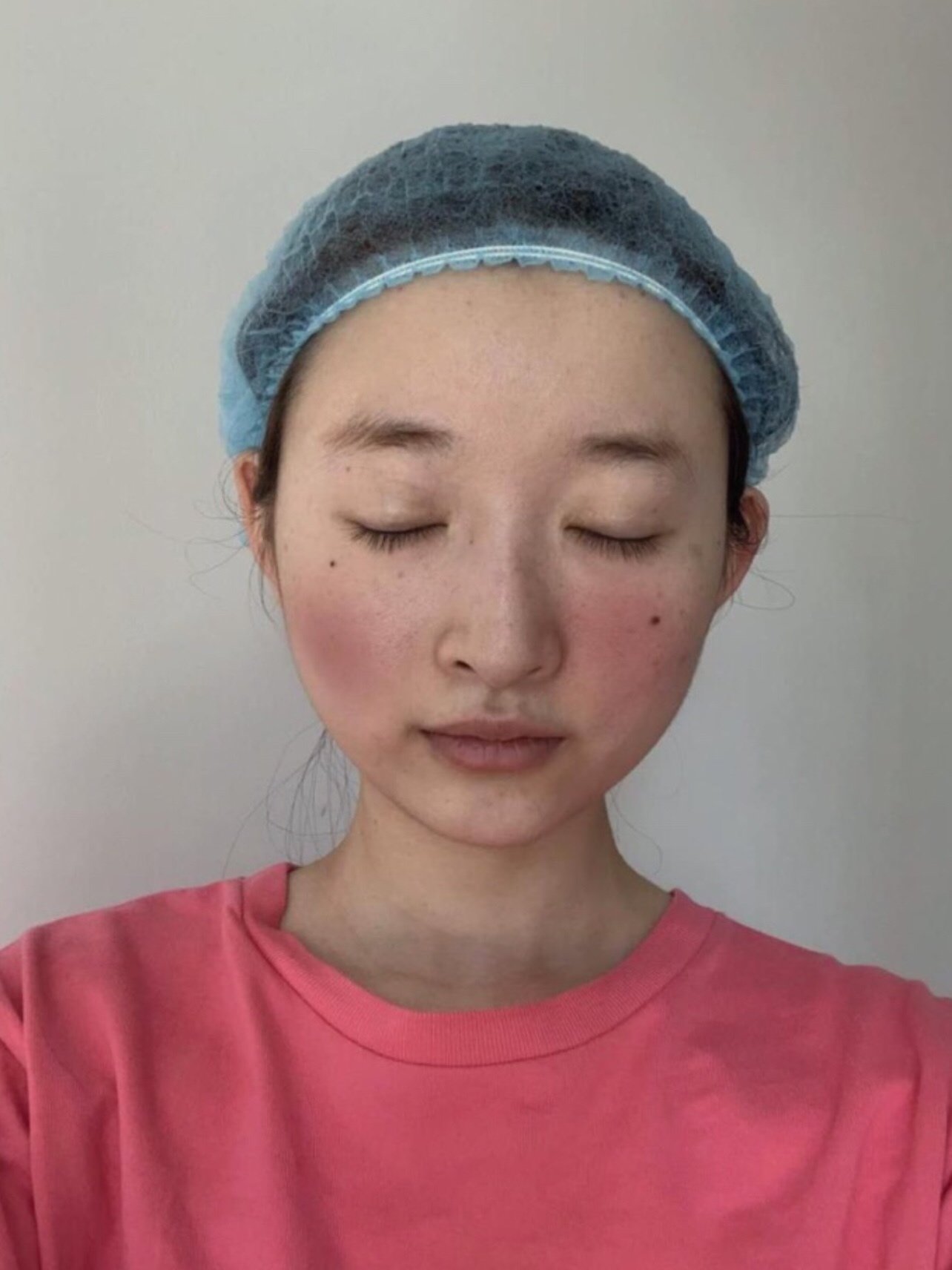 【术后恢复期】其实光子嫩肤整体来讲还可以,治疗过程_圈子-新氧美容