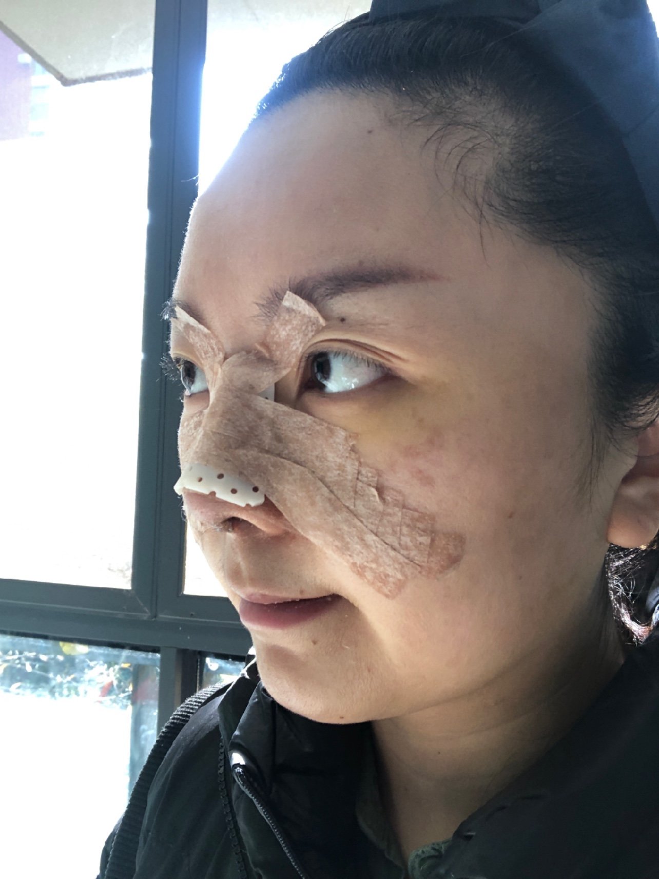 昨天就已经出院啦,现在鼻子依然是包扎着的,除了有点_圈子-新氧美容