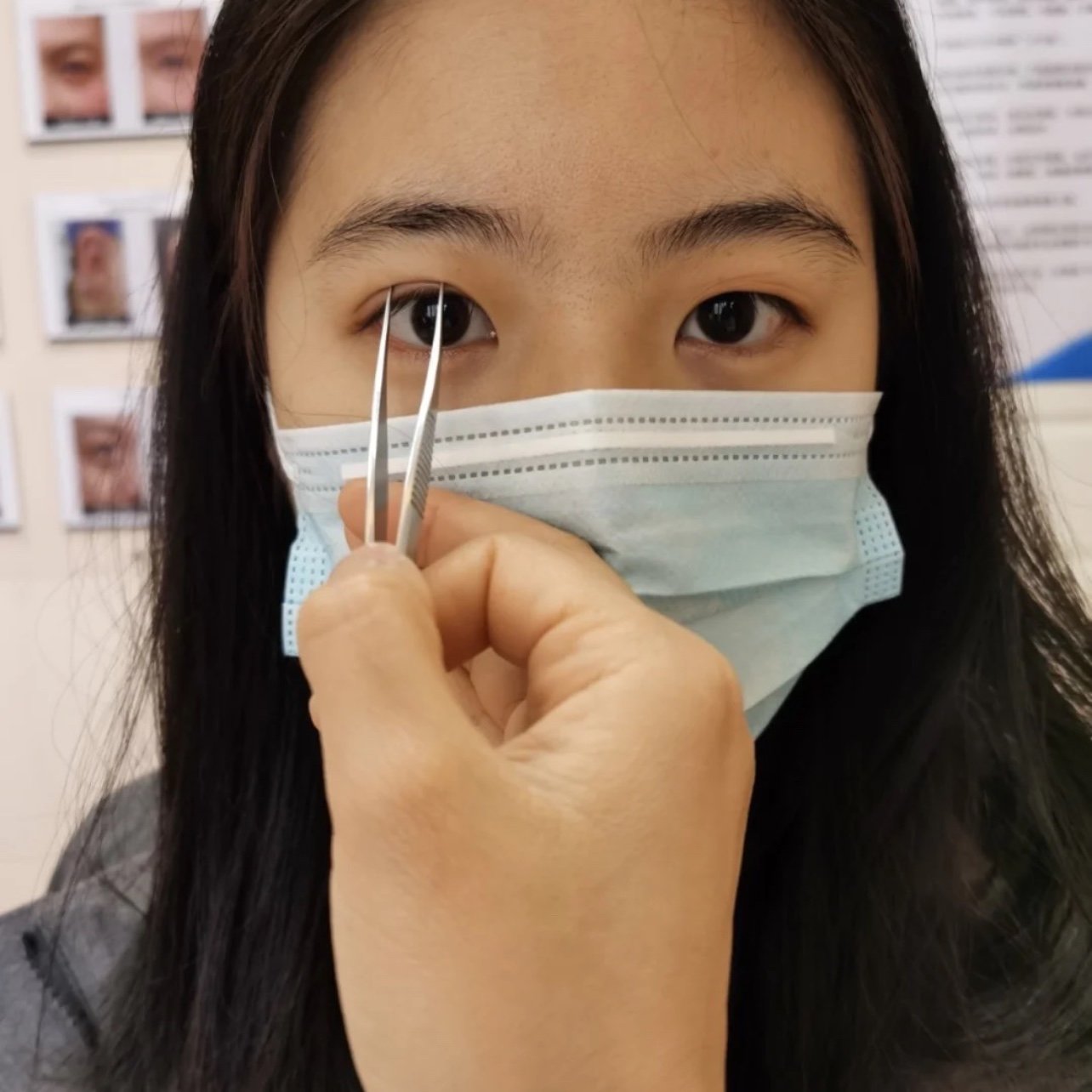 术后前3天都在冰敷希望消肿快一点眼睛有一点痒