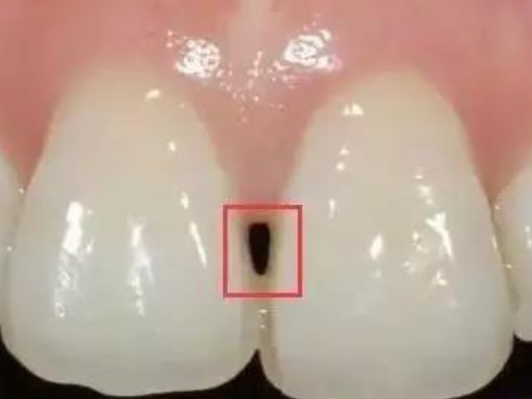 部分人在戴牙套之后出现了"黑三角"这是怎么回事?