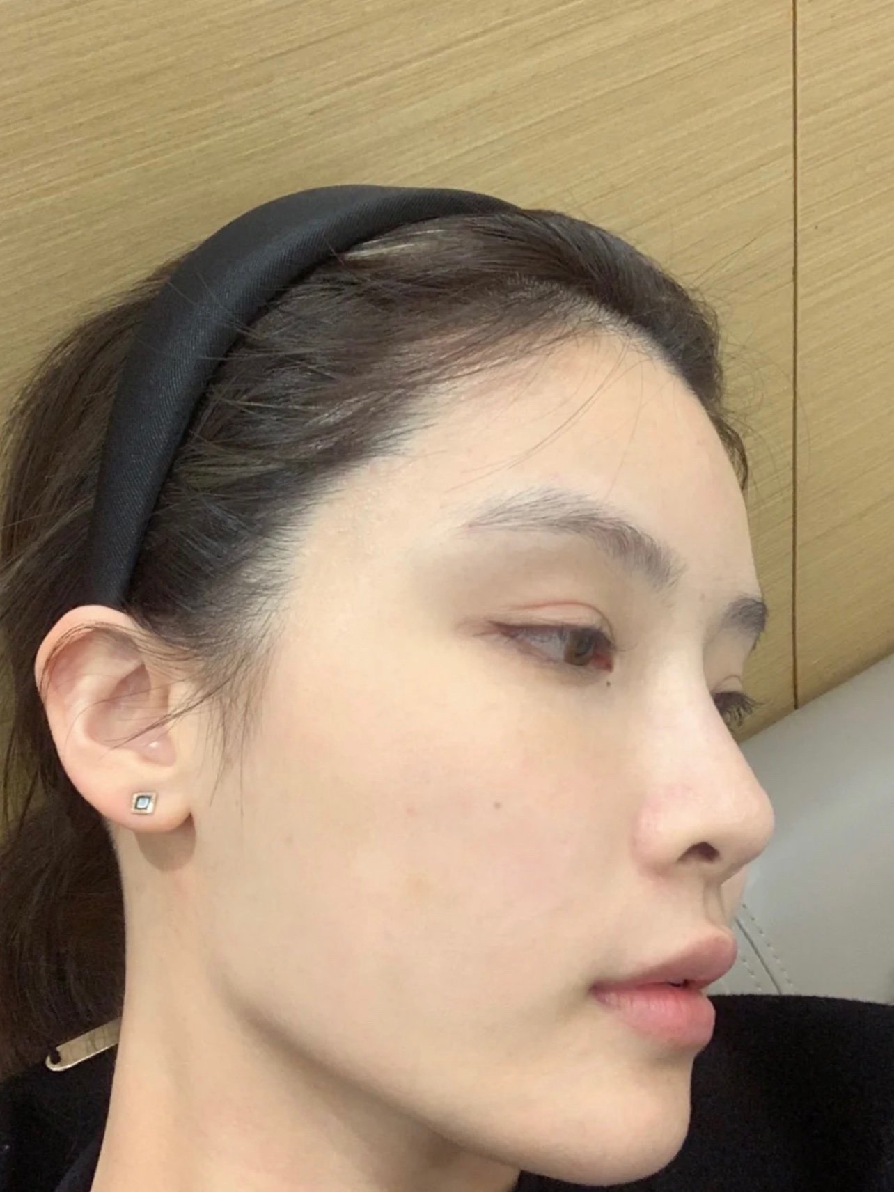 打了下颌缘提升针之后现在下颌缘的轮廓线都要清晰很多_圈子-新氧美容