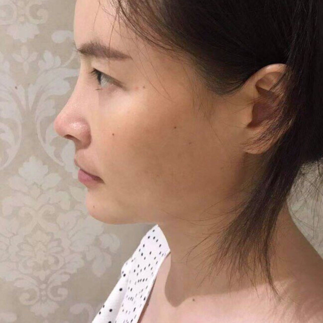 我脸部最大的缺陷就是鼻子塌陷了,一直就比较在意这个_圈子-新氧美容