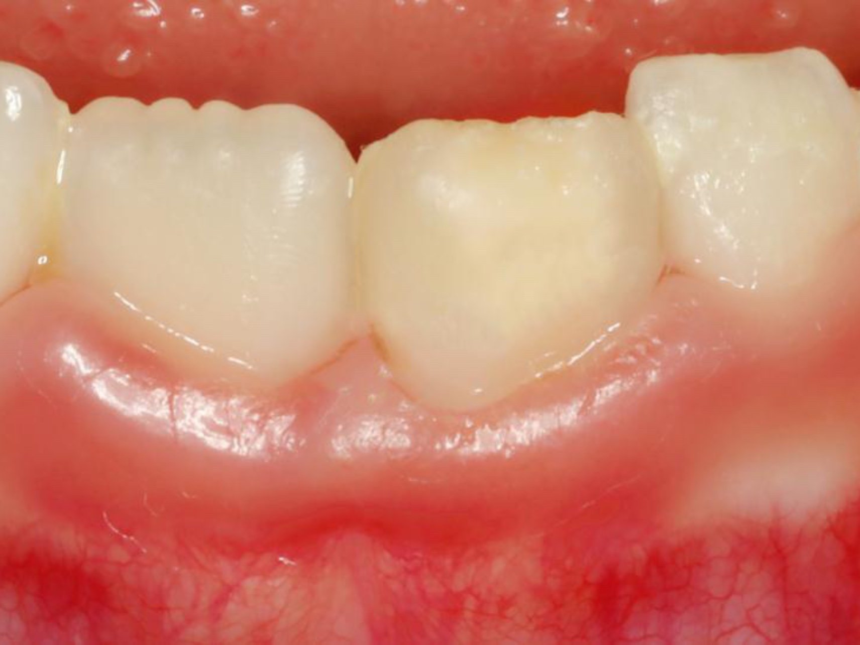 常规复查,妈妈主诉新长的恒牙黄黄的,经医生检查发现是牙釉质发育不全